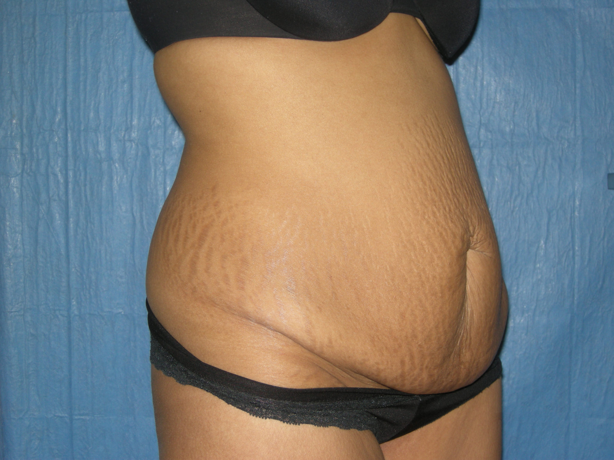 Tummy Tuck Patient Photo - Case 3465 - before view-4
