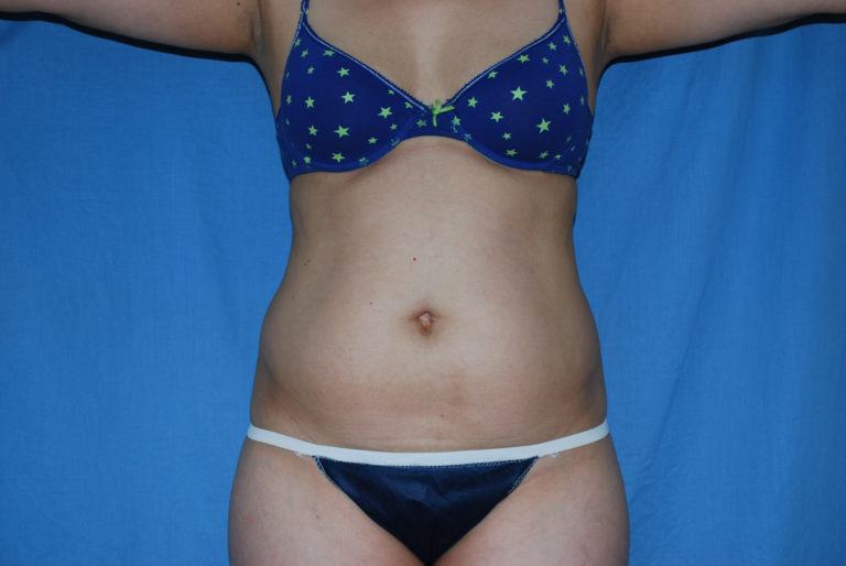 Liposuction - Case 3021 - Before