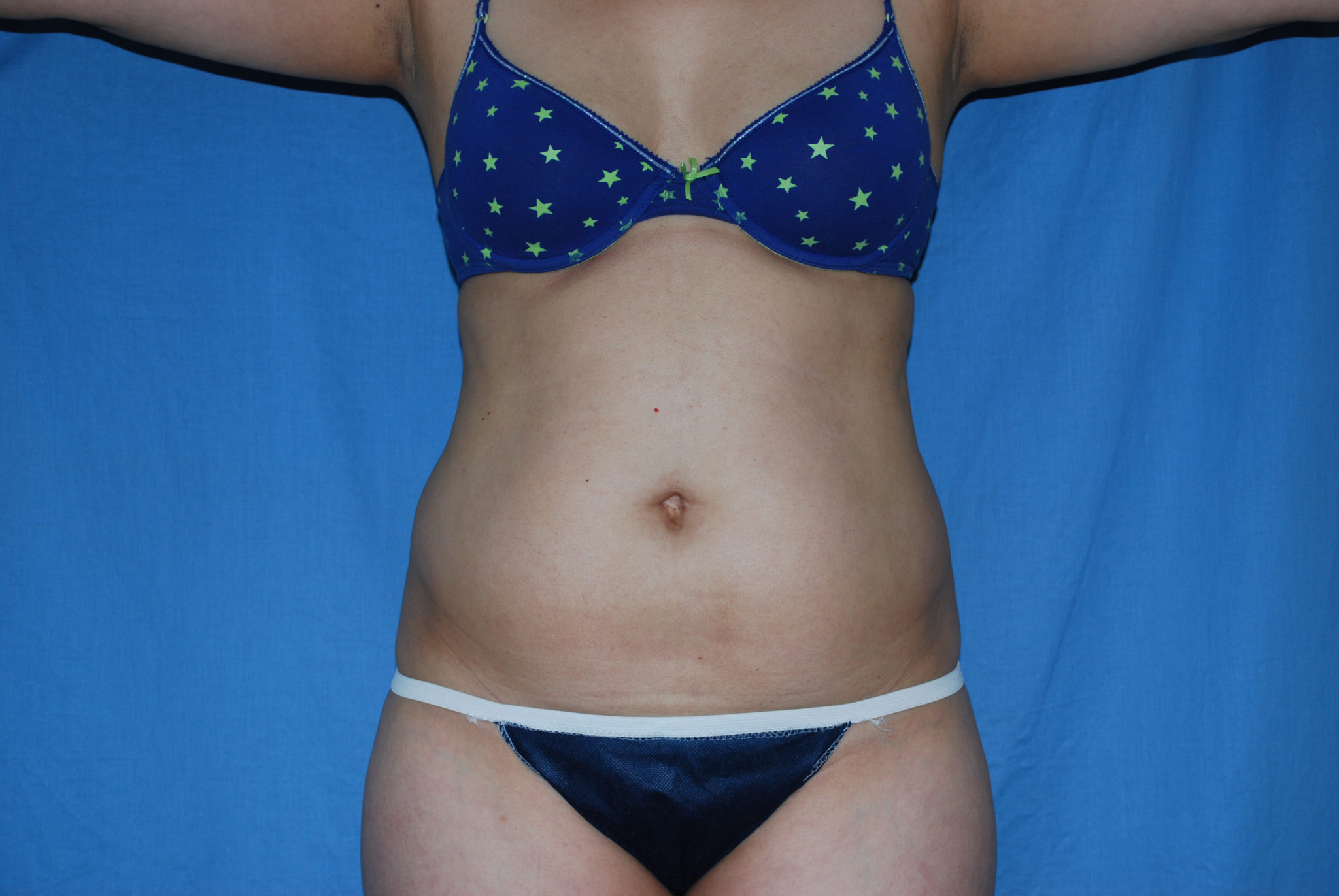 Liposuction Patient Photo - Case 3021 - before view-0