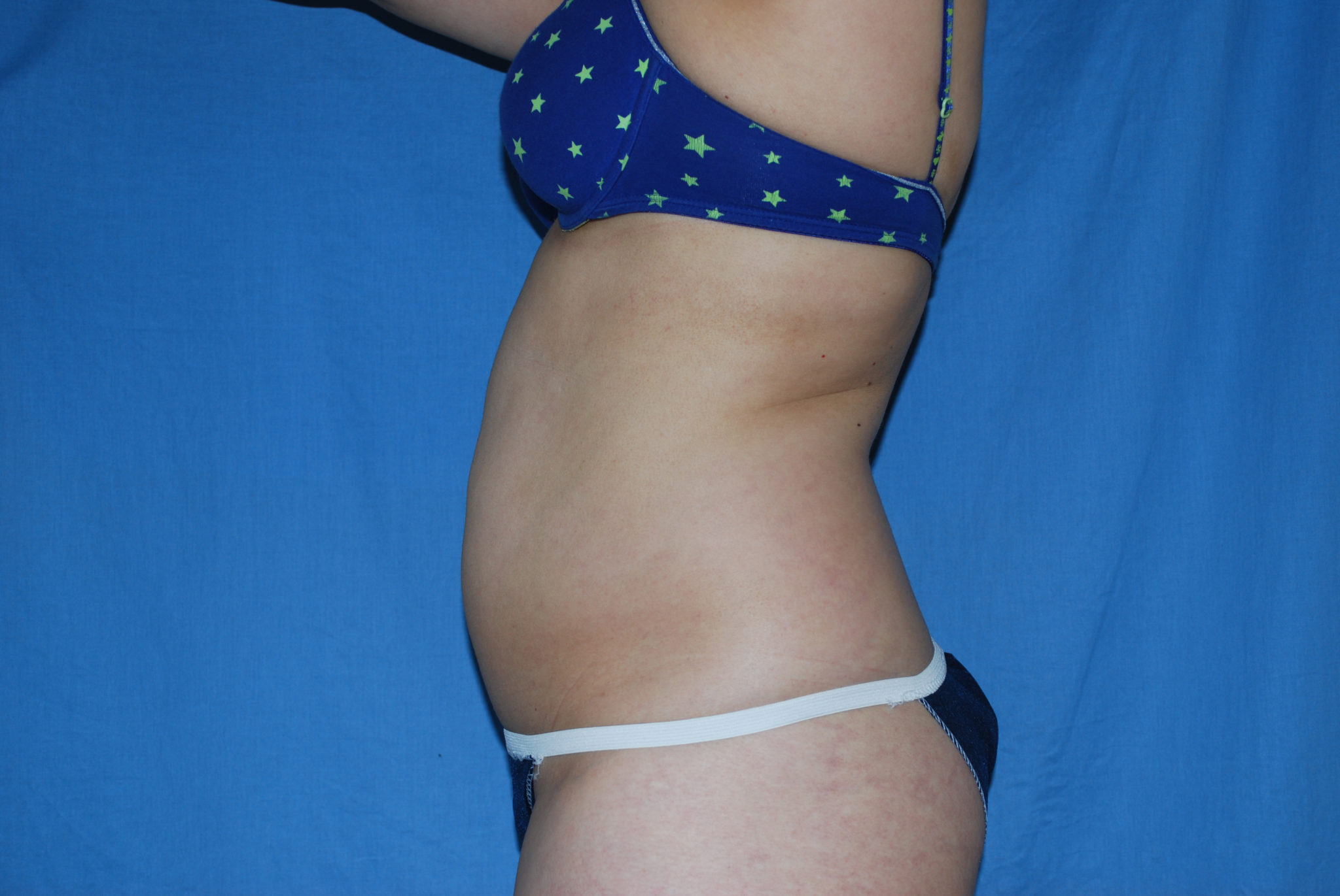 Liposuction Patient Photo - Case 3021 - before view-1