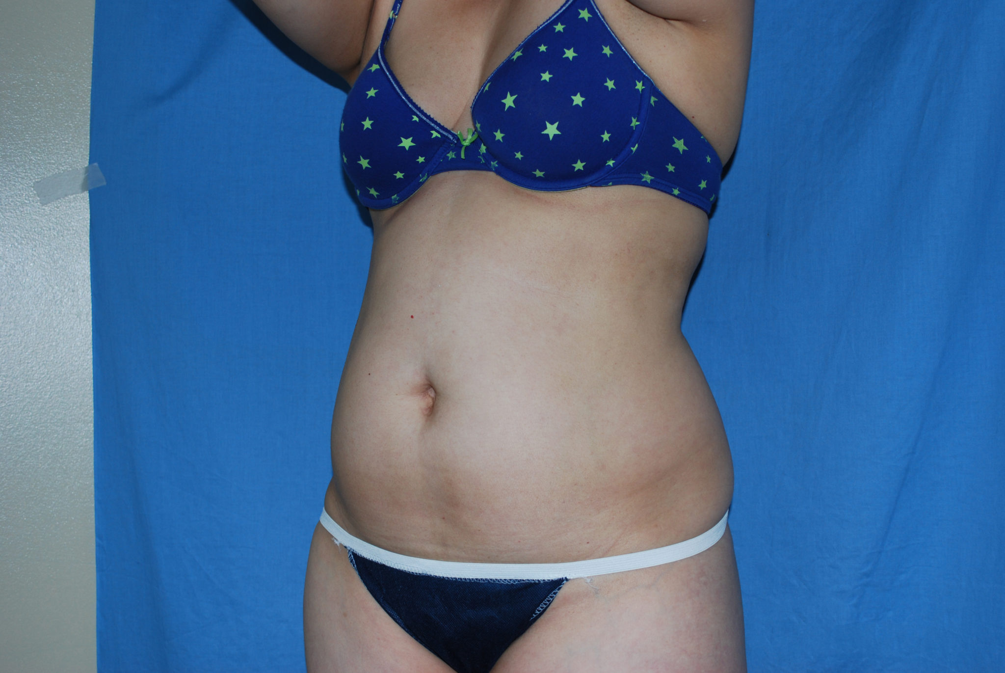 Liposuction Patient Photo - Case 3021 - before view-2