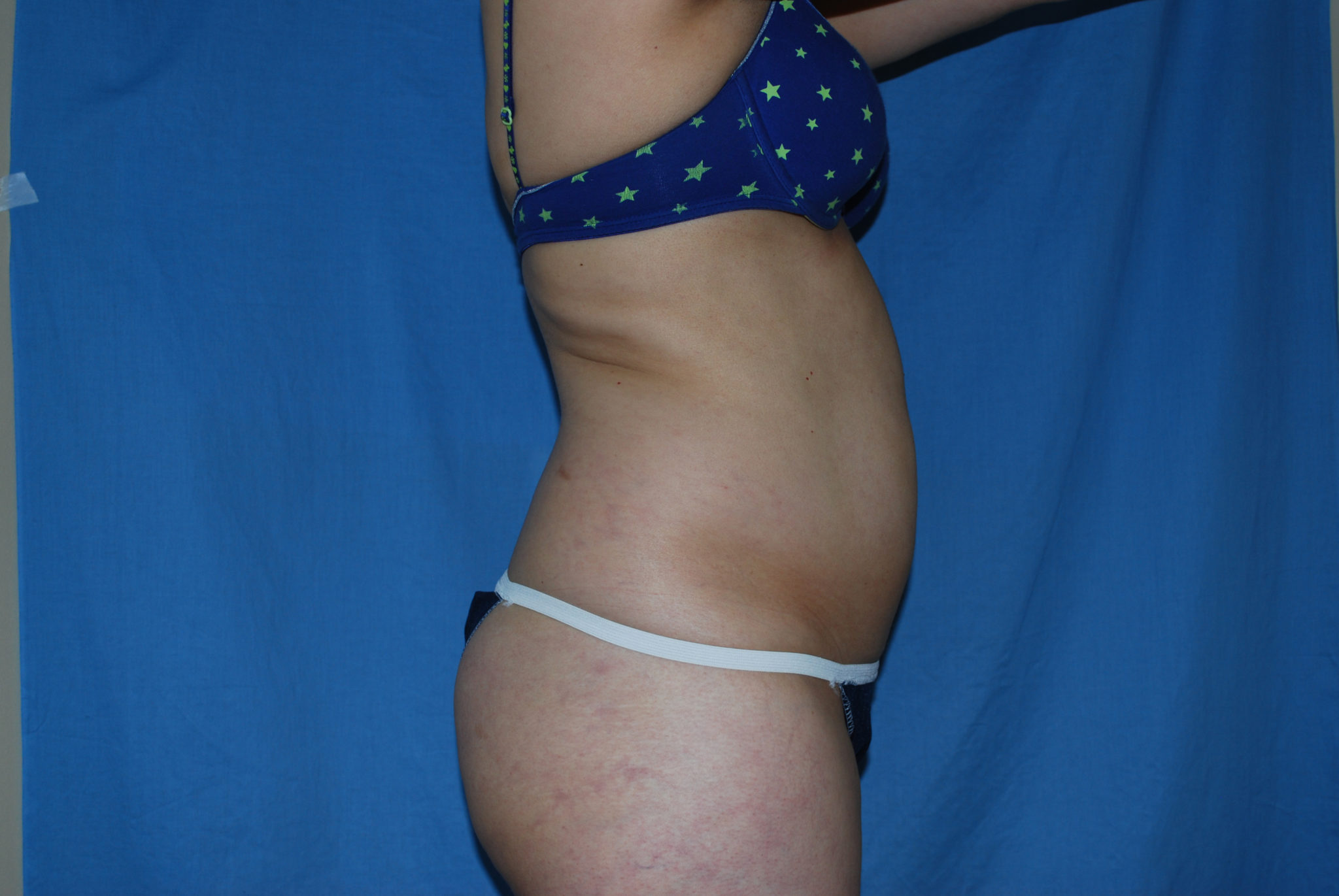 Liposuction Patient Photo - Case 3021 - before view-3