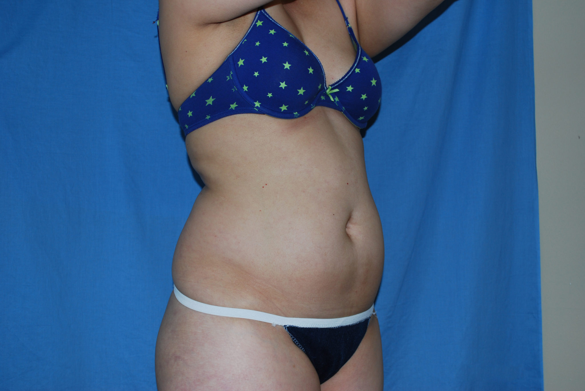 Liposuction Patient Photo - Case 3021 - before view-4