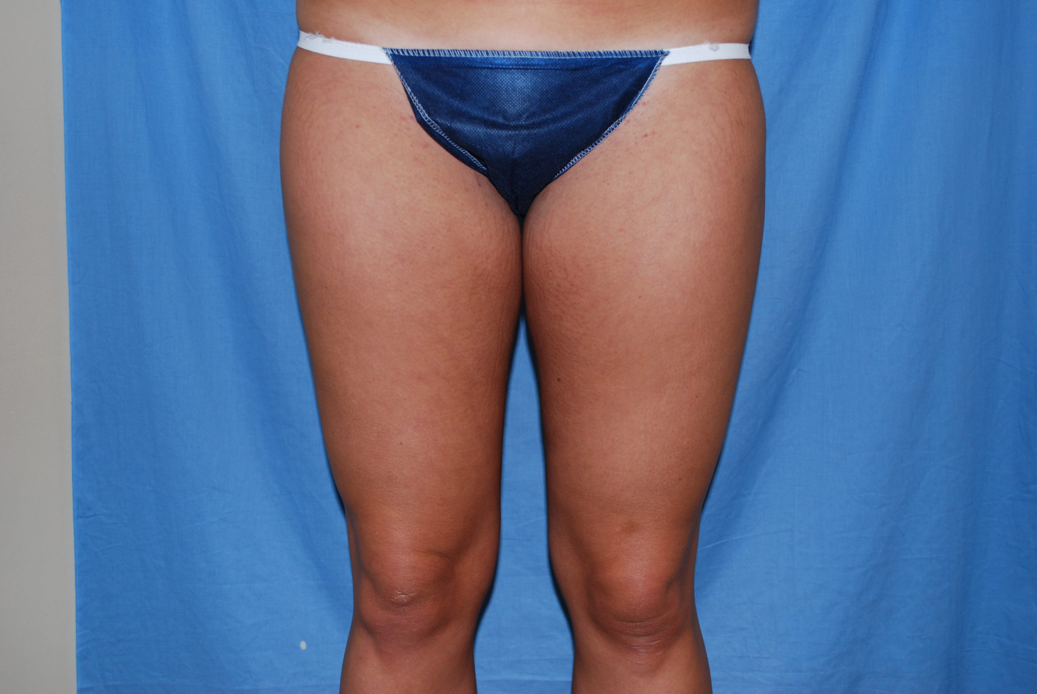 Liposuction Patient Photo - Case 3237 - before view-1