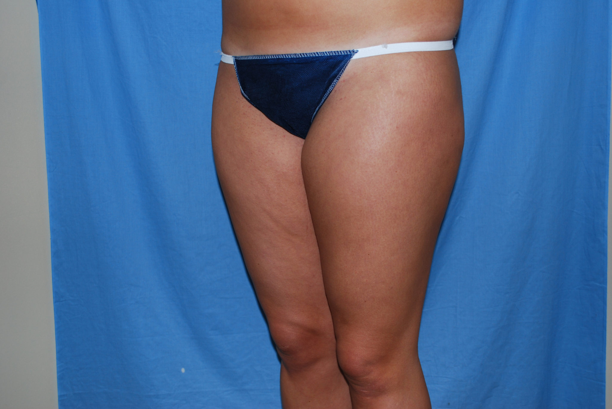 Liposuction Patient Photo - Case 3237 - before view-3