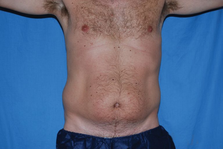 Liposuction - Case 3506 - Before