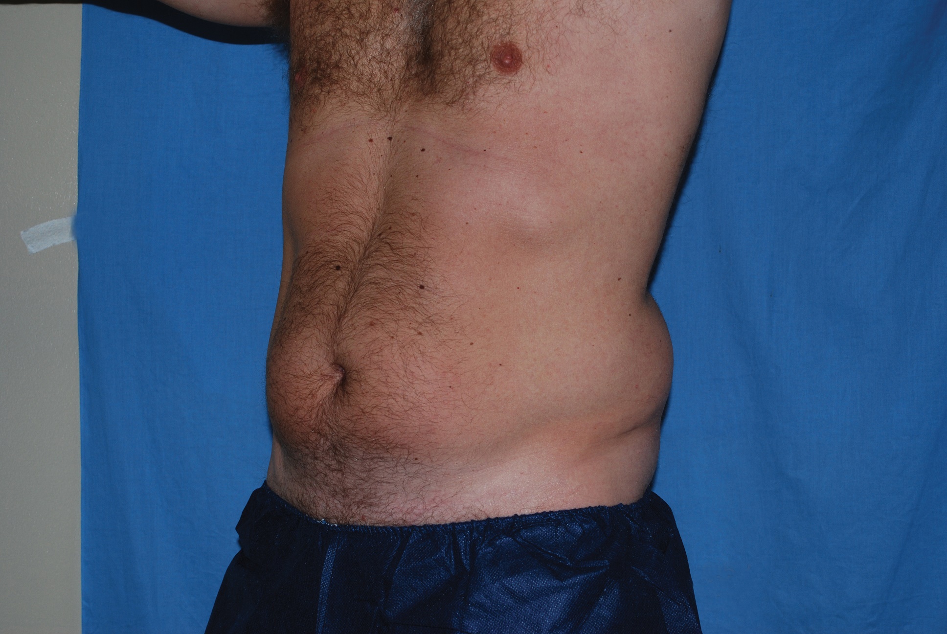 Liposuction Patient Photo - Case 3506 - before view-3