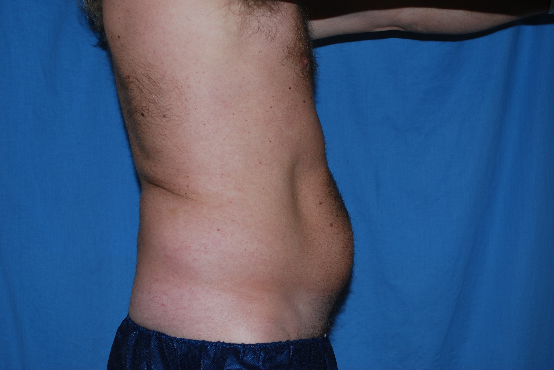 Liposuction Patient Photo - Case 3506 - before view-1