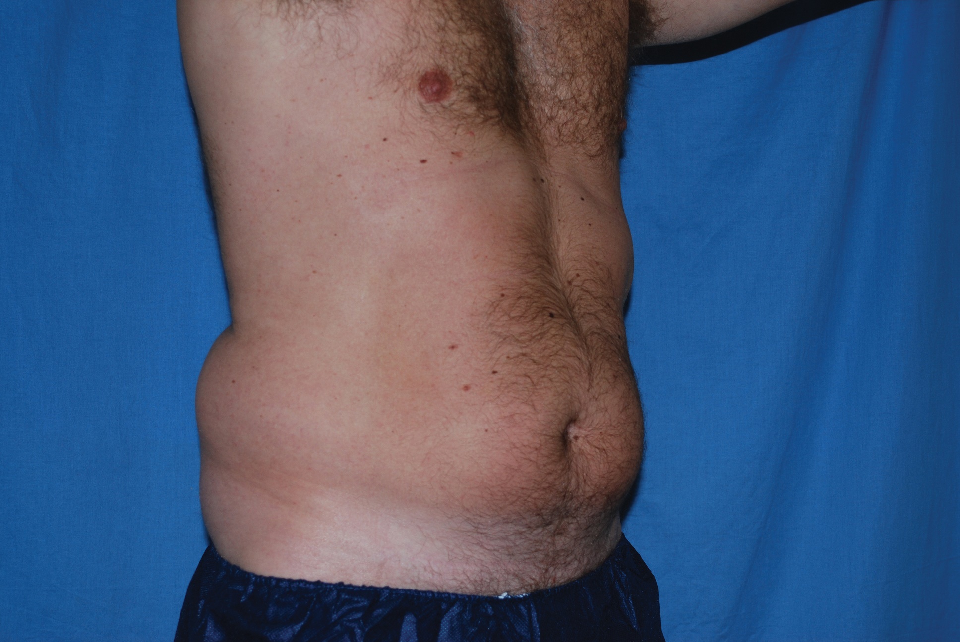 Liposuction Patient Photo - Case 3506 - before view-2