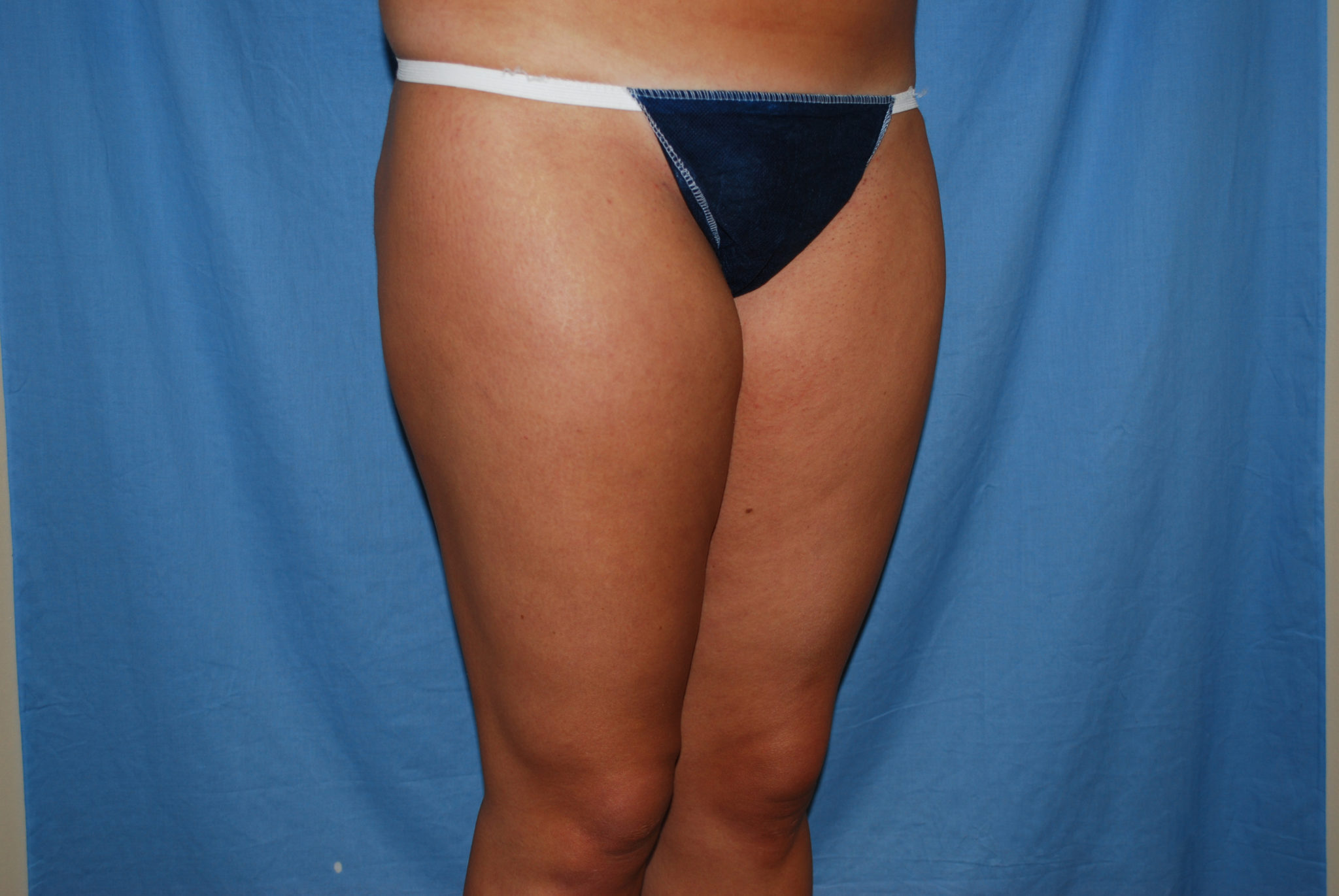 Liposuction Patient Photo - Case 3237 - before view-5