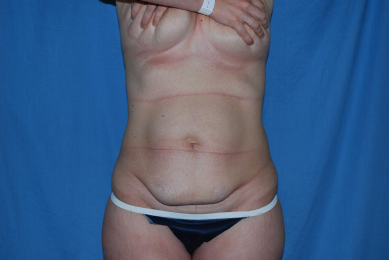 Liposuction - Case 3495 - Before