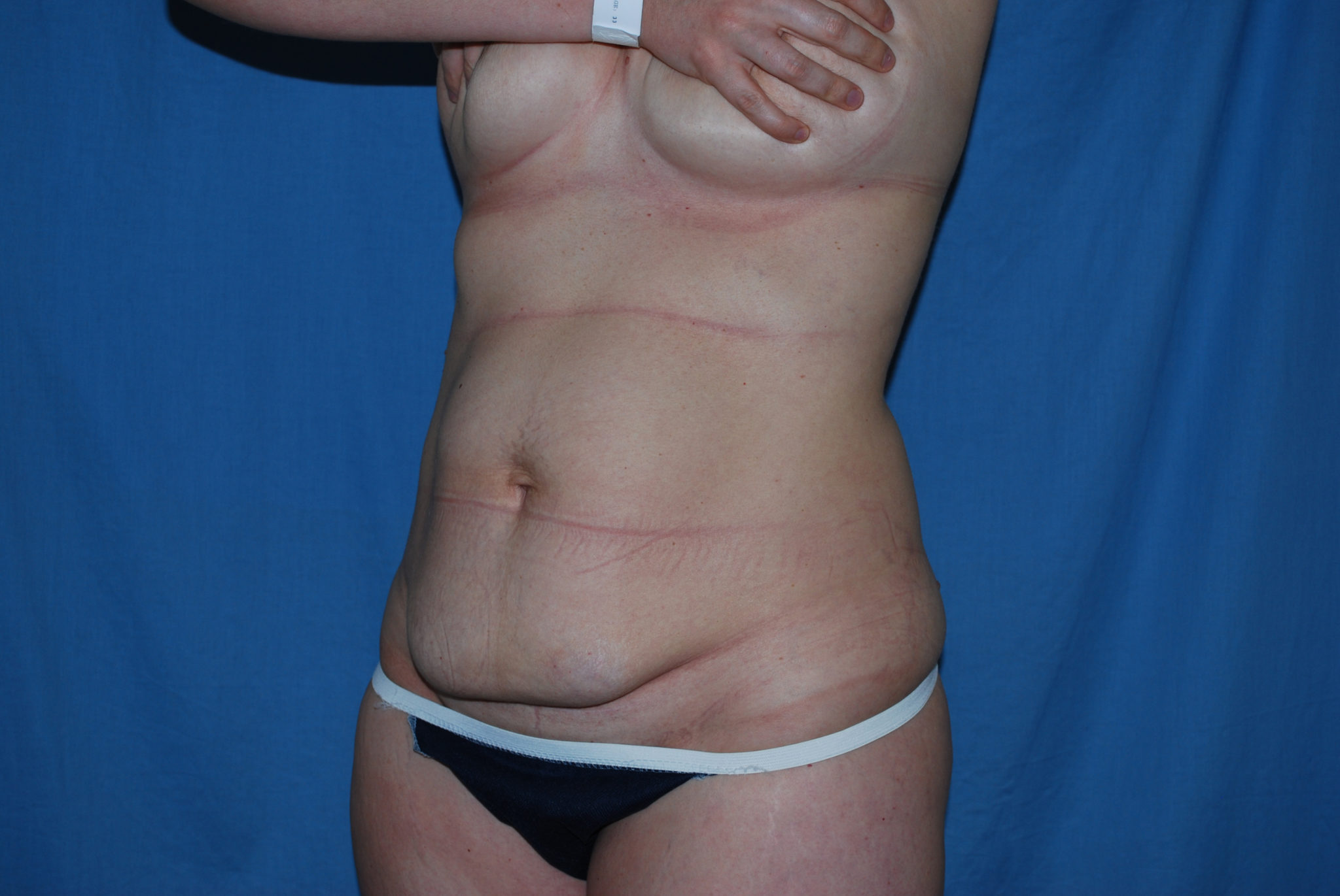 Liposuction Patient Photo - Case 3495 - before view-2