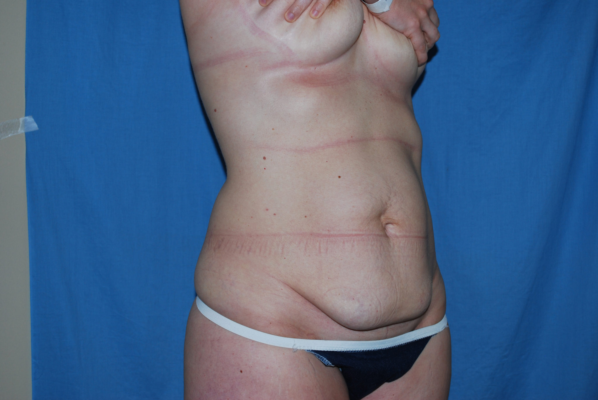 Liposuction Patient Photo - Case 3495 - before view-4