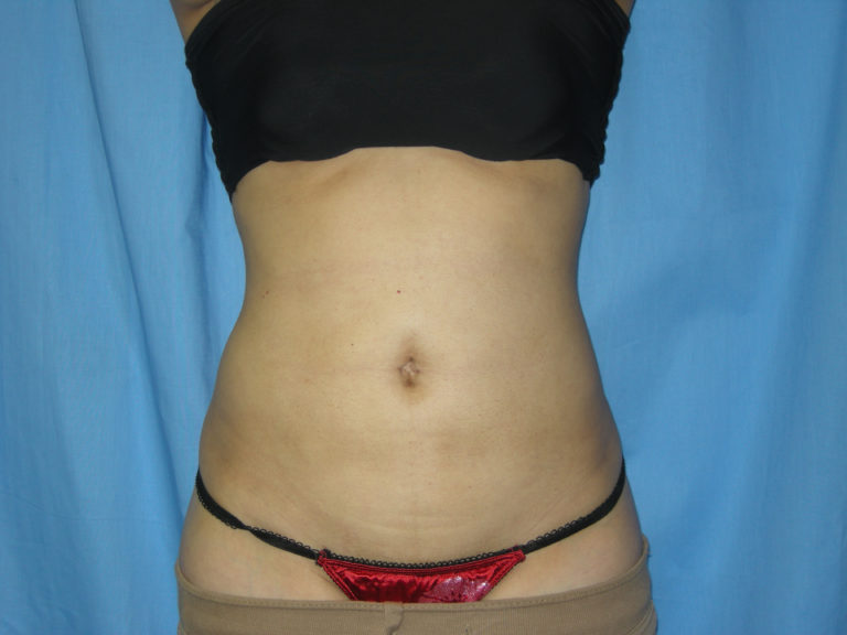 Liposuction - Case 3021 - After