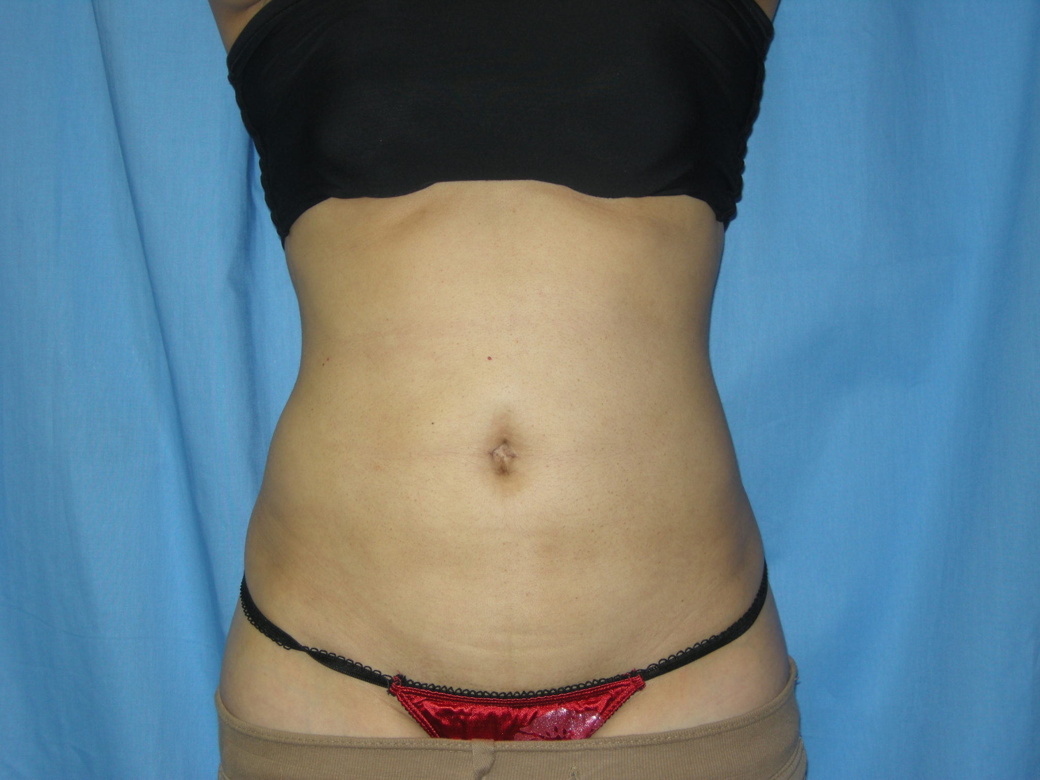 Liposuction Patient Photo - Case 3021 - after view