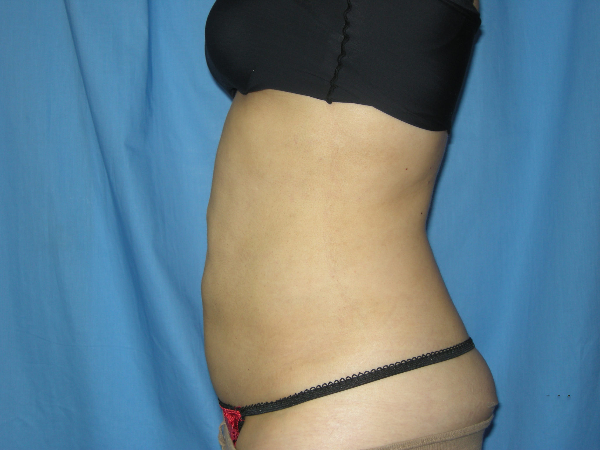Liposuction Patient Photo - Case 3021 - after view-1