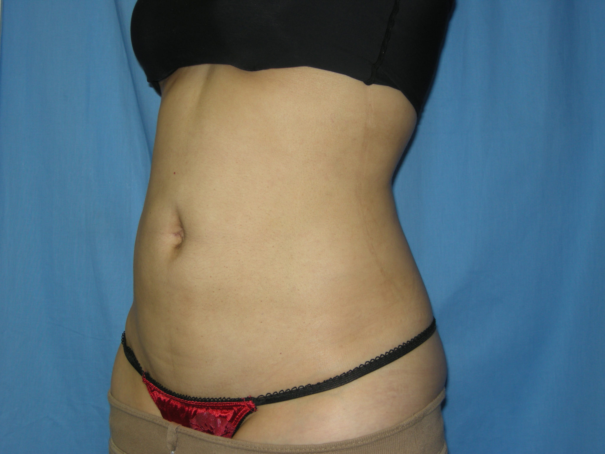 Liposuction Patient Photo - Case 3021 - after view-2