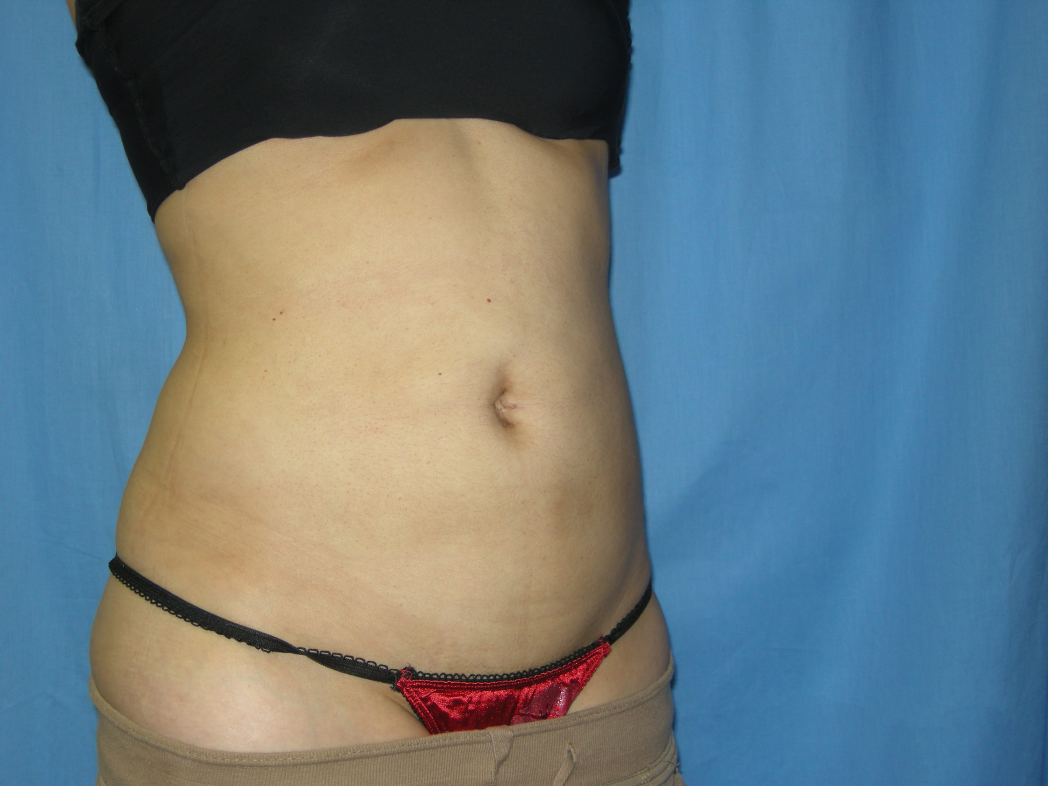 Liposuction Patient Photo - Case 3021 - after view-4