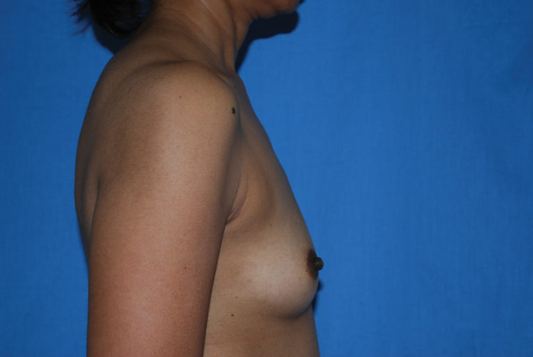 Breast Augmentation - Case 4289 - Before