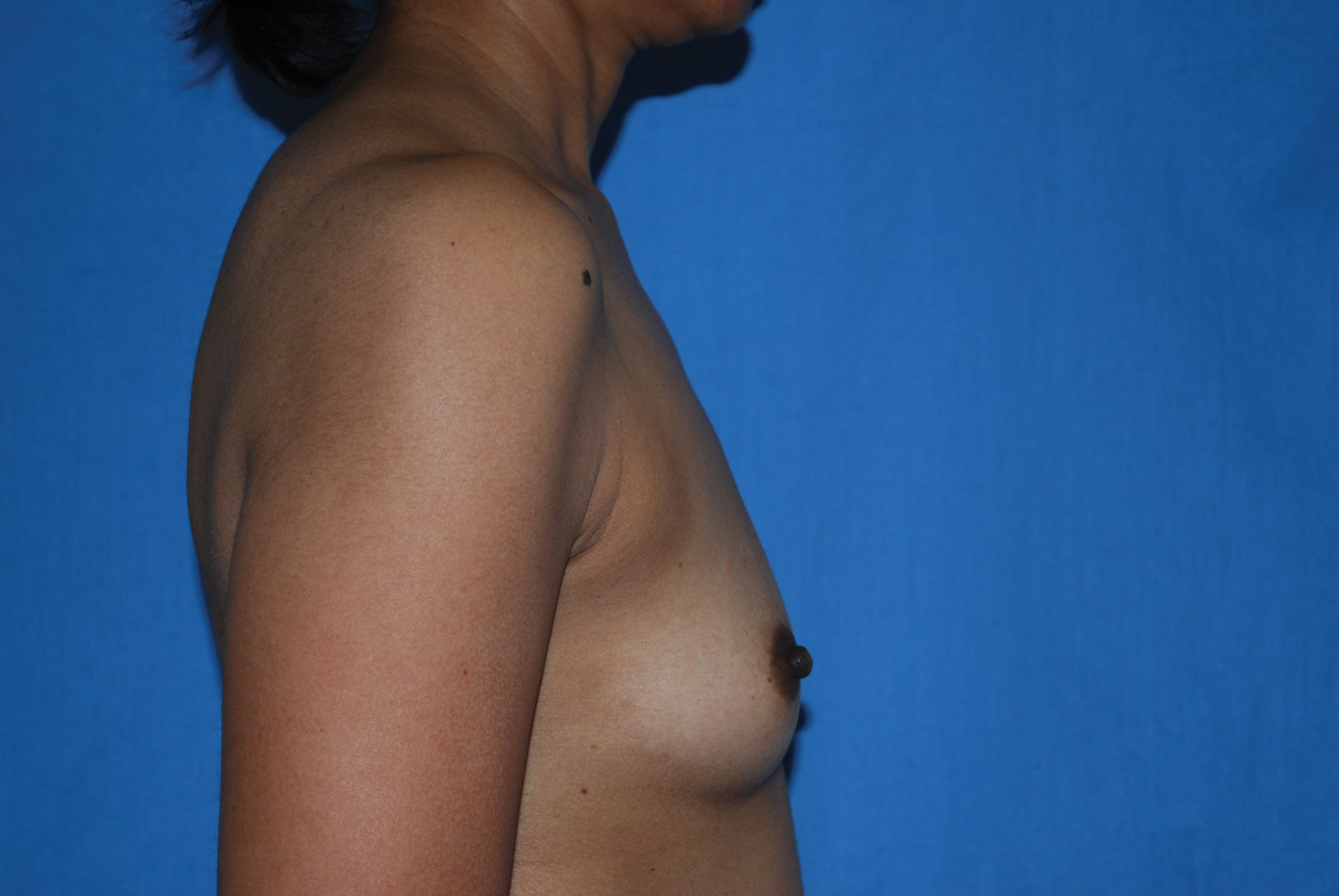 Breast Augmentation Patient Photo - Case 4289 - before view-