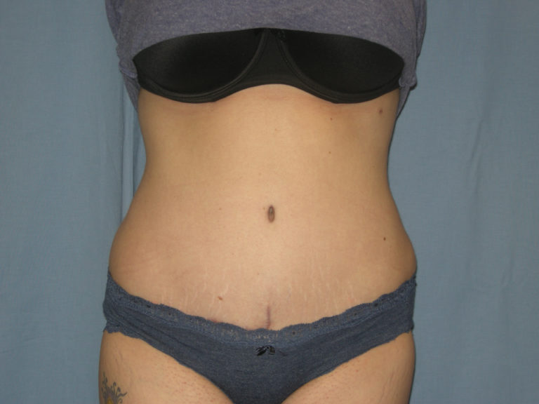 Tummy Tuck - Case 3332 - After