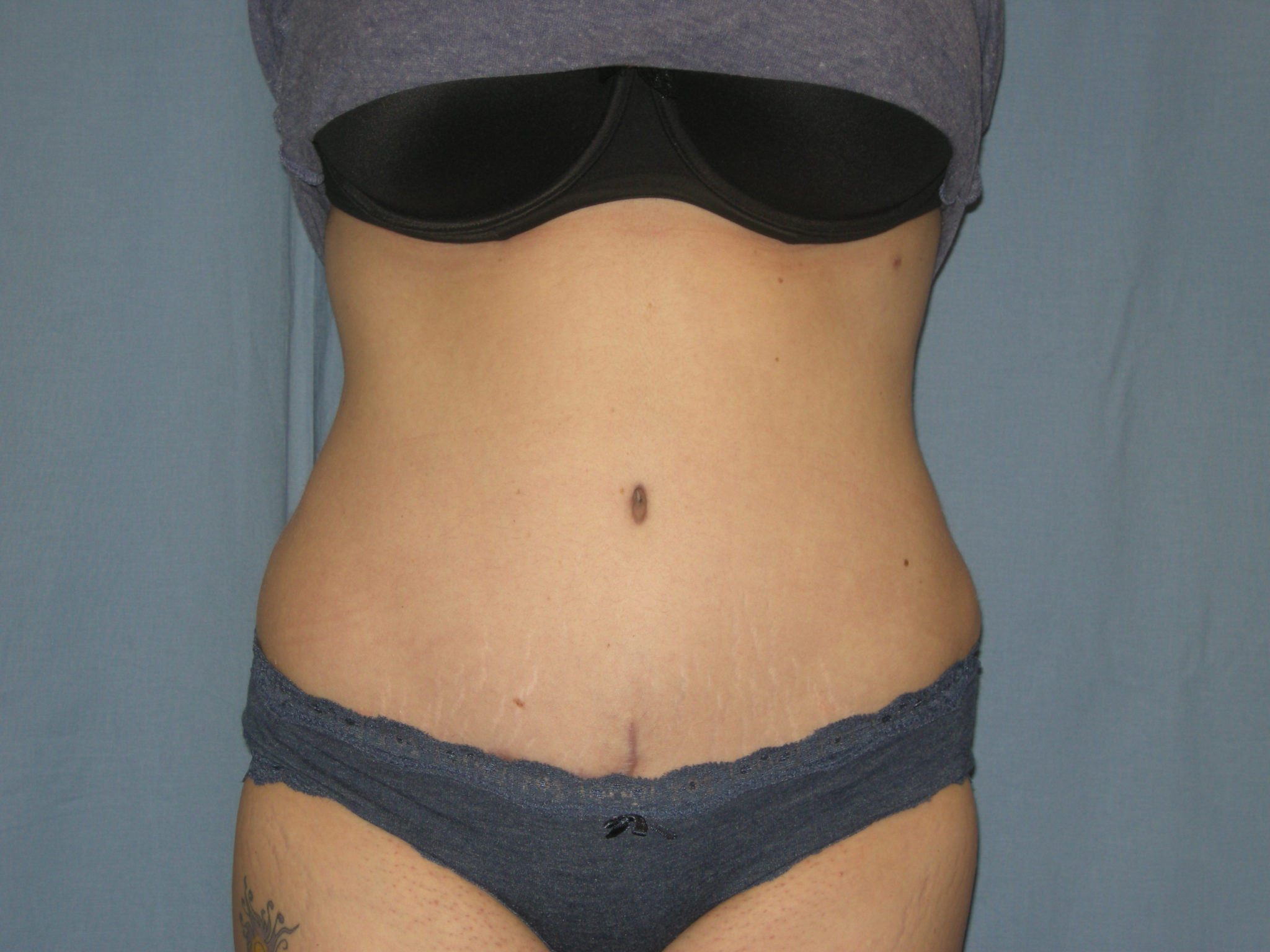 Tummy Tuck Patient Photo - Case 3332 - after view-0