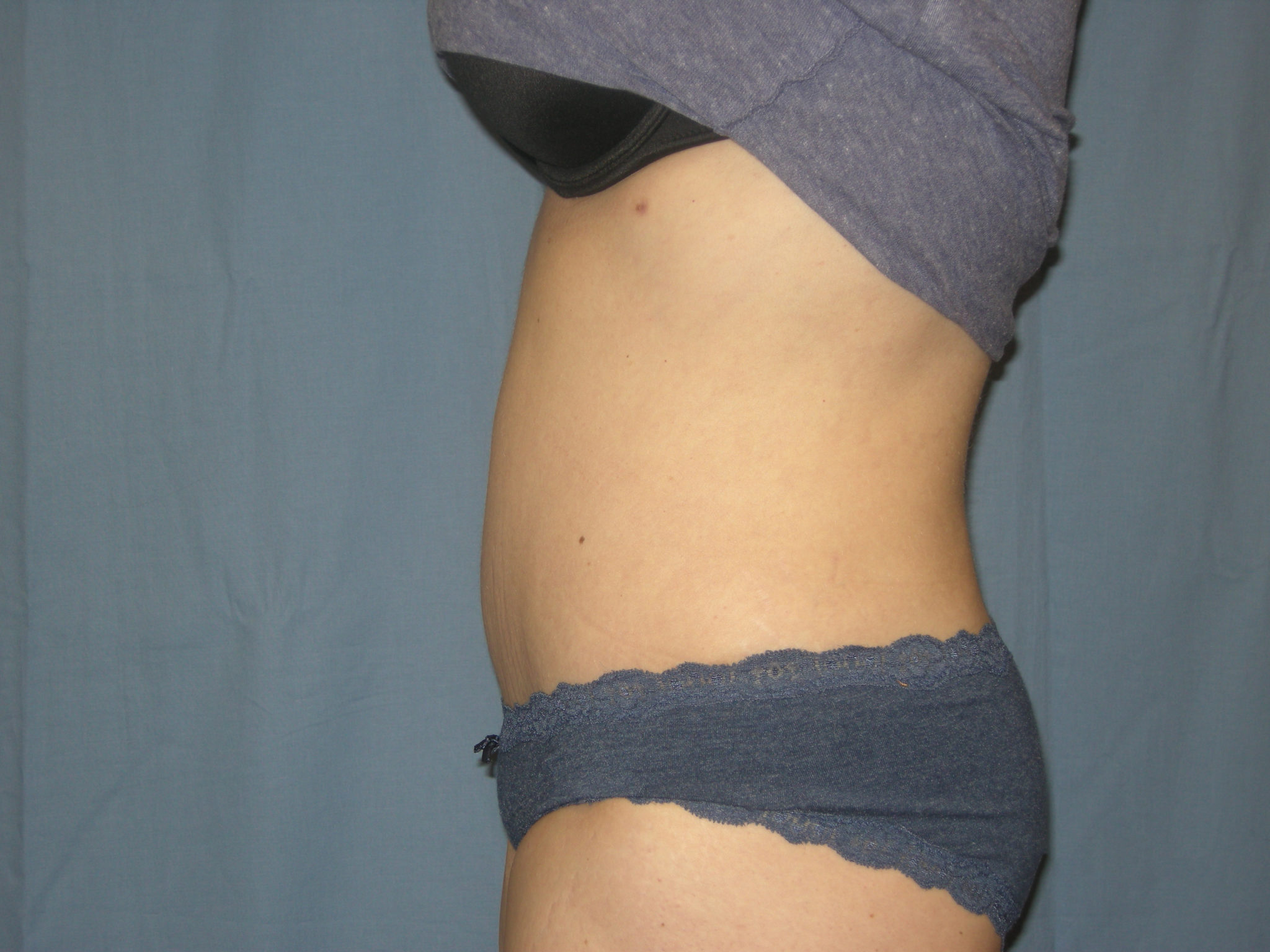Tummy Tuck Patient Photo - Case 3332 - after view-1