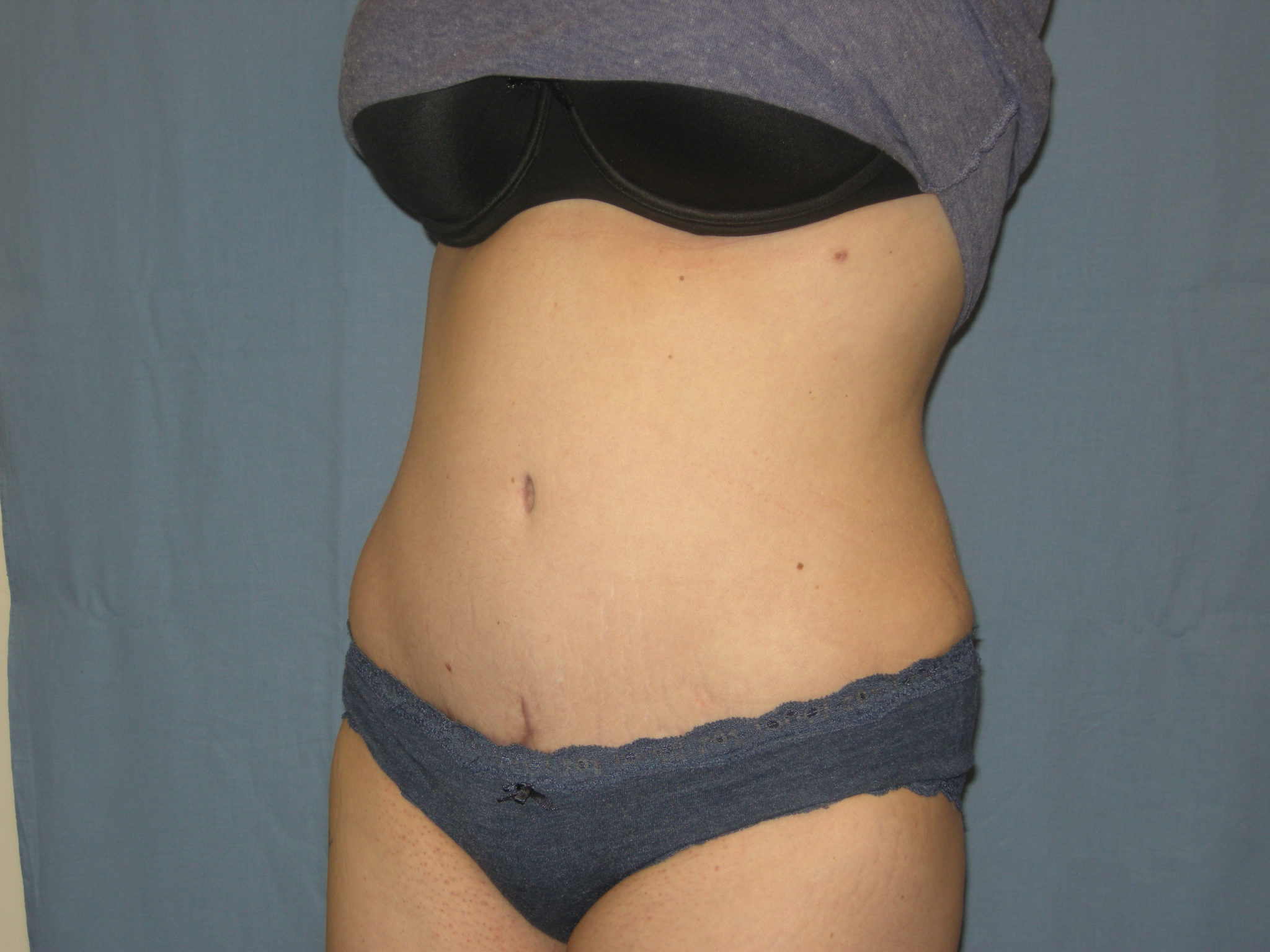 Tummy Tuck Patient Photo - Case 3332 - after view-2