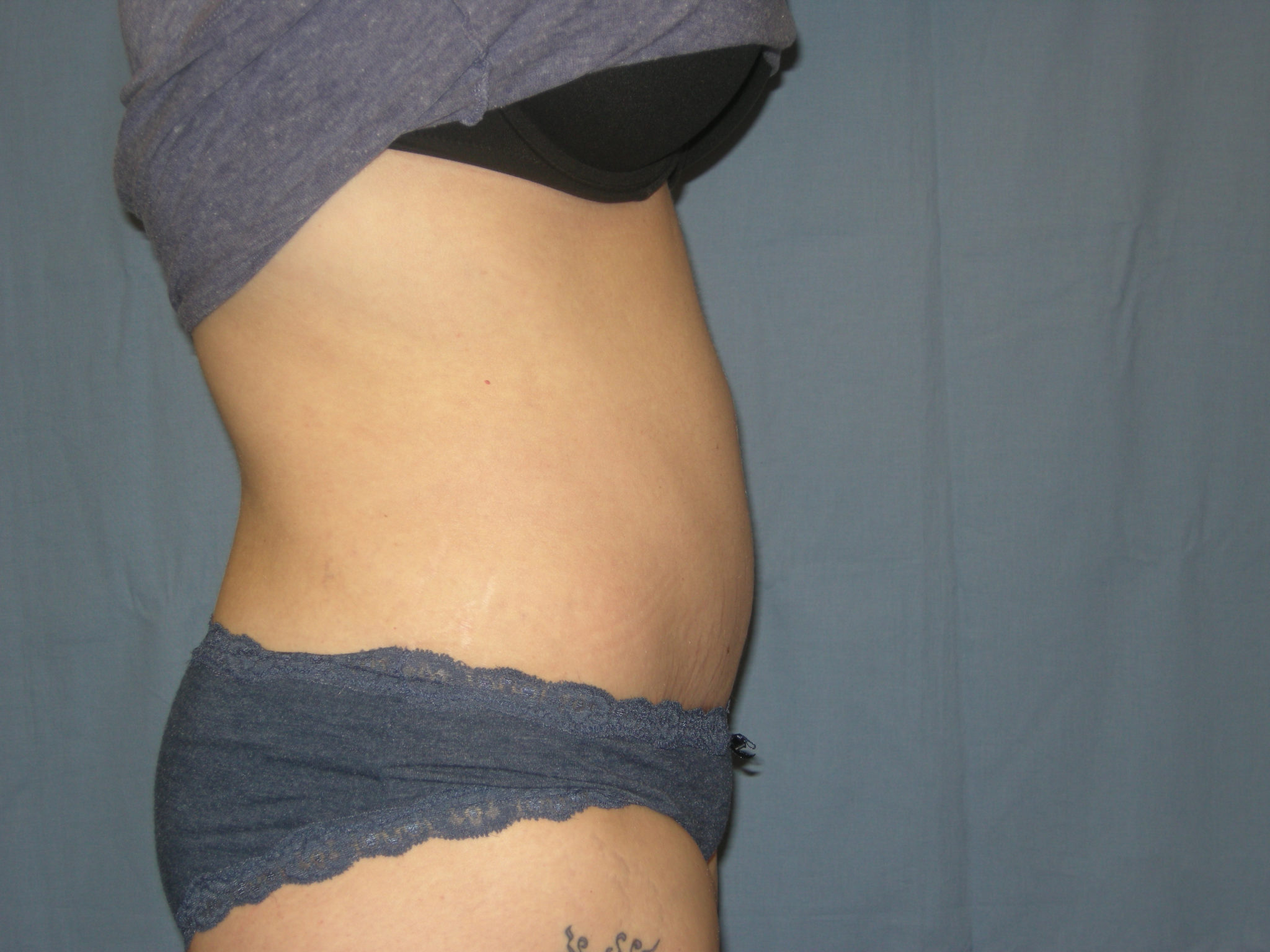 Tummy Tuck Patient Photo - Case 3332 - after view-3