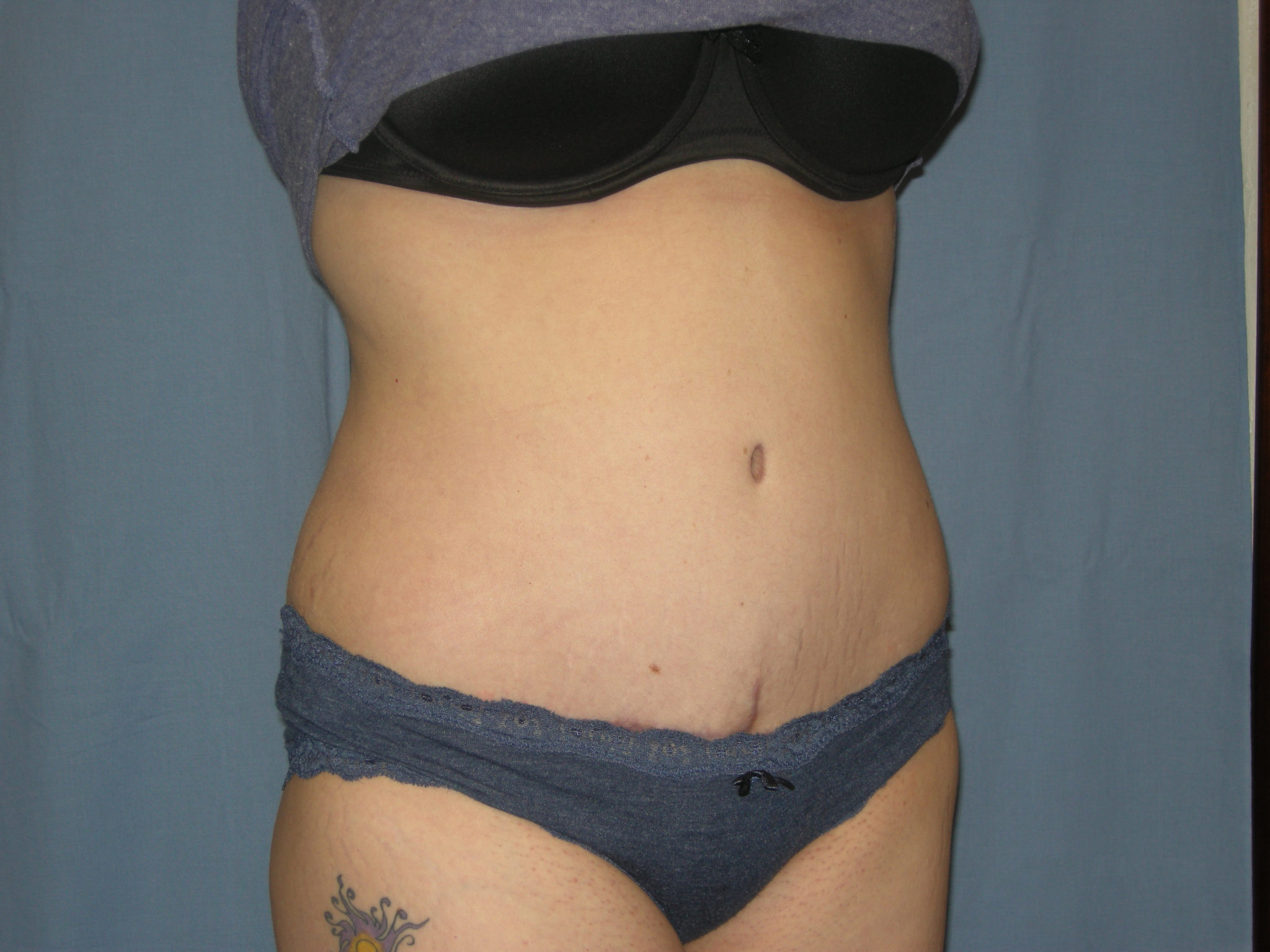 Tummy Tuck Patient Photo - Case 3332 - after view-4