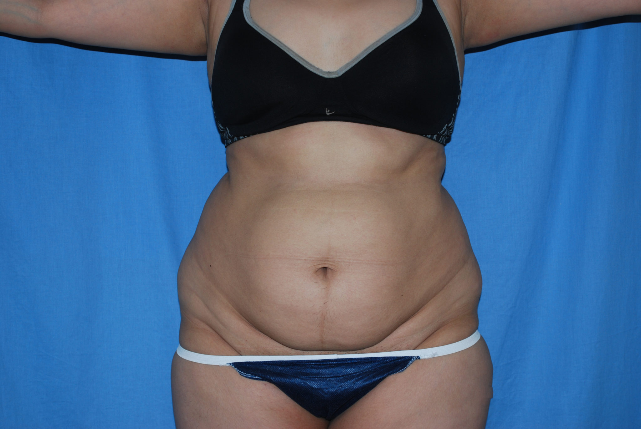 Tummy Tuck Patient Photo - Case 3389 - before view-0