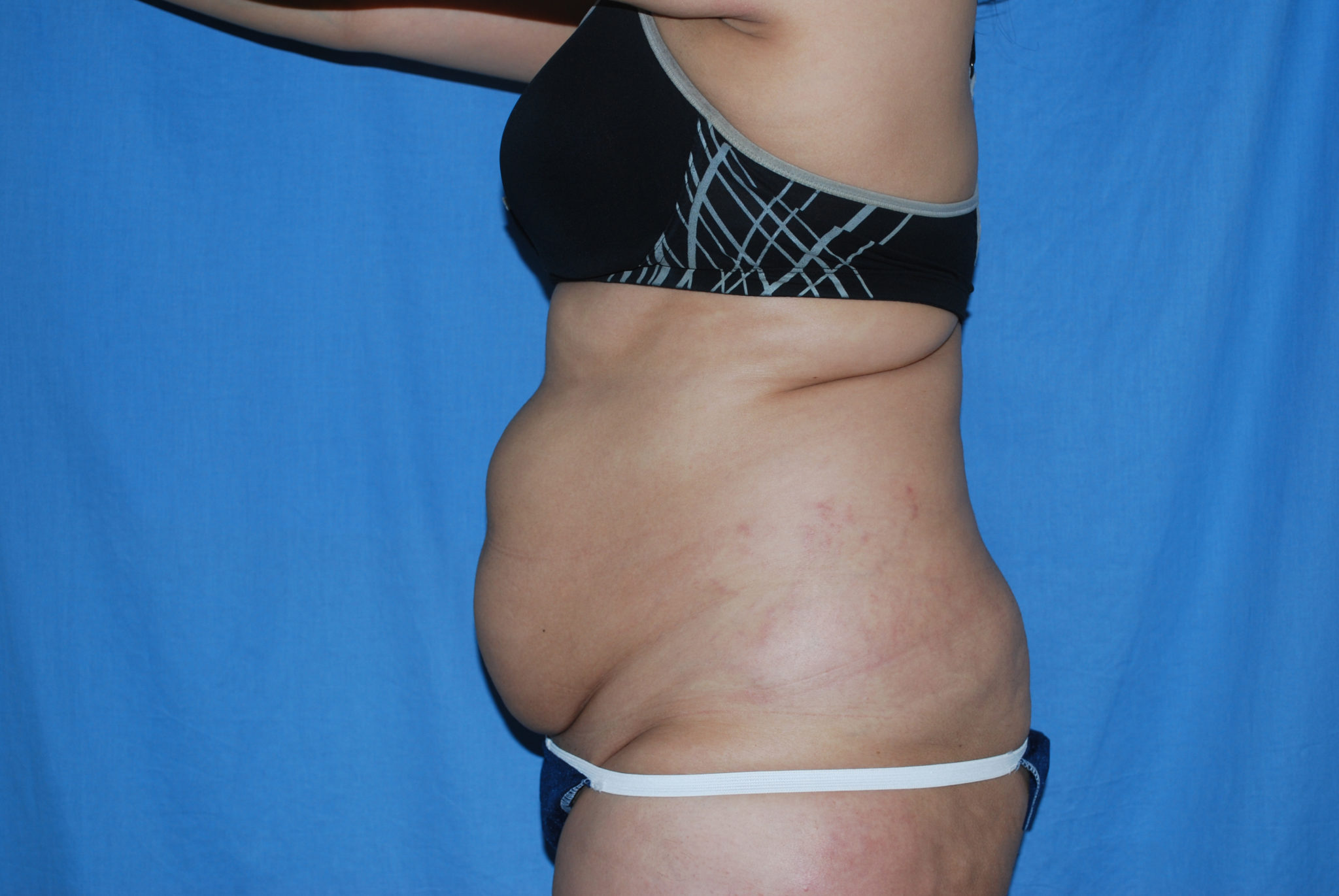 Tummy Tuck Patient Photo - Case 3389 - before view-1
