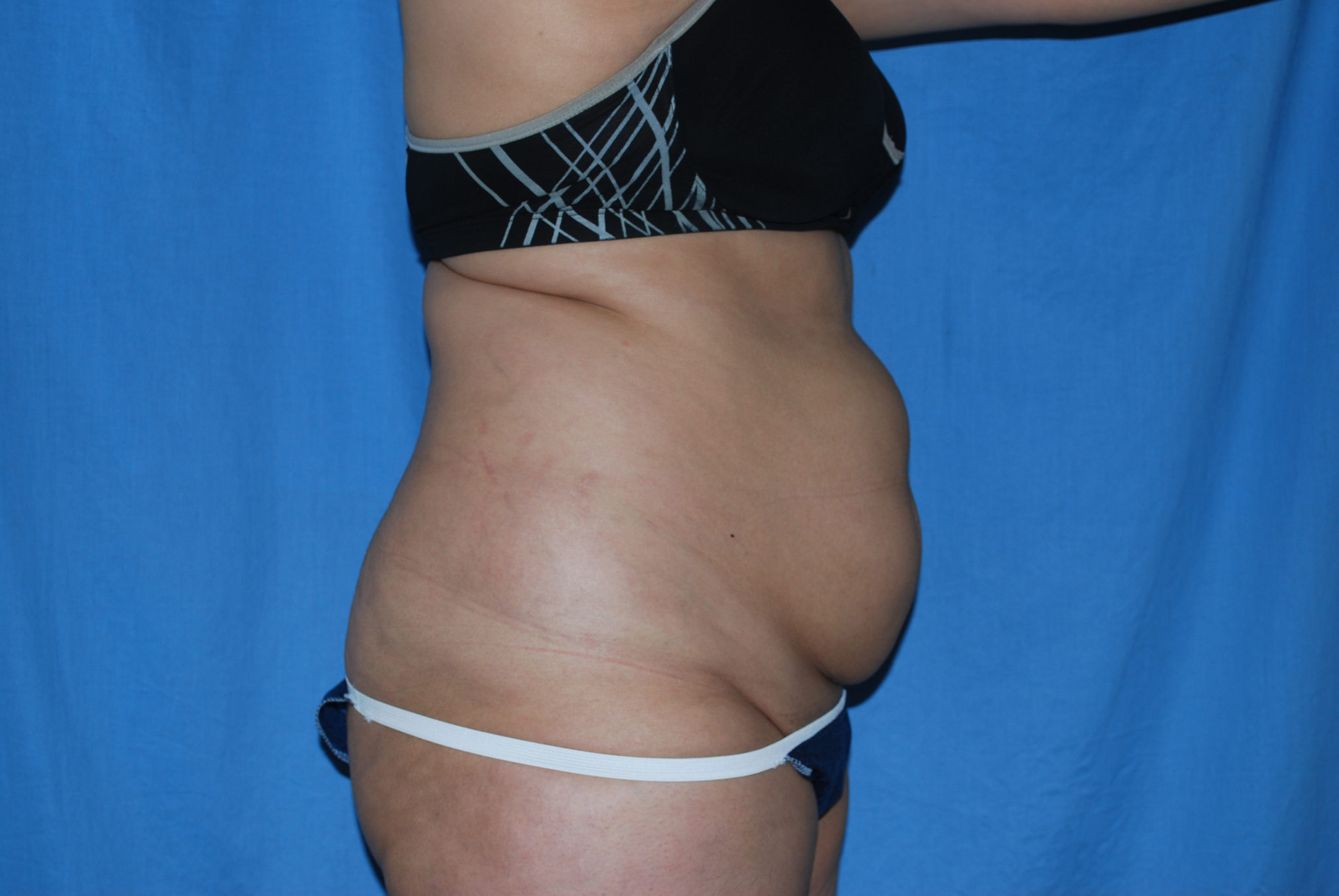 Tummy Tuck Patient Photo - Case 3389 - before view-3