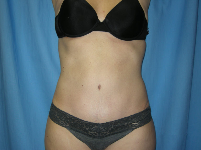 Liposuction - Case 3495 - After