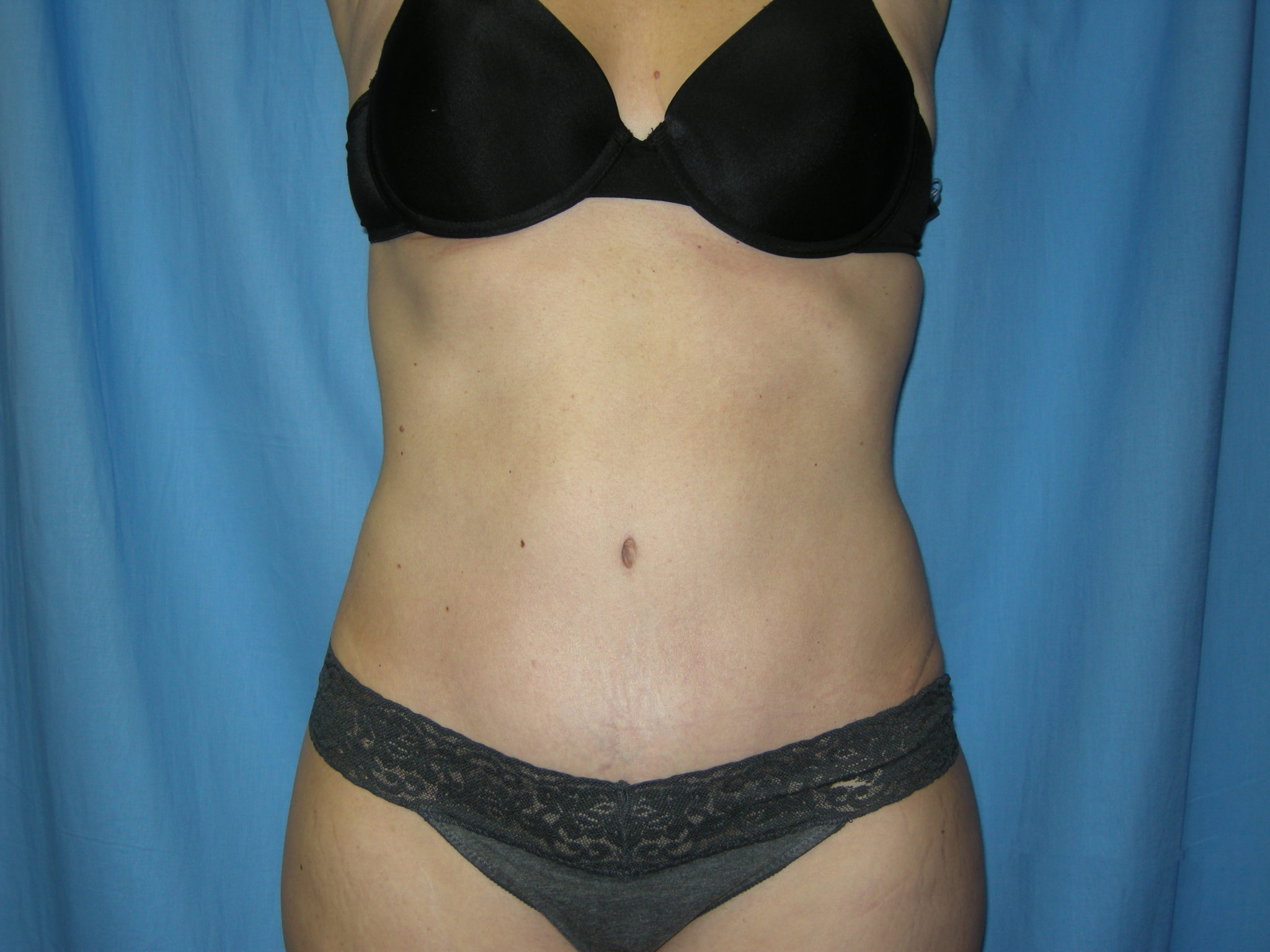 Liposuction Patient Photo - Case 3495 - after view-0