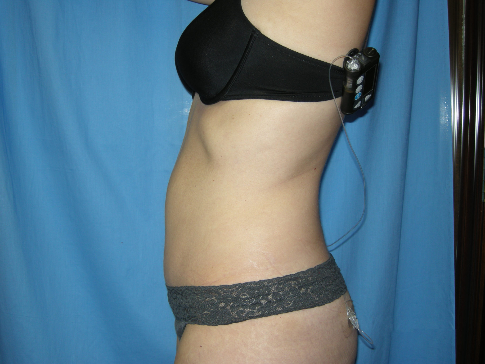 Liposuction Patient Photo - Case 3495 - after view-1