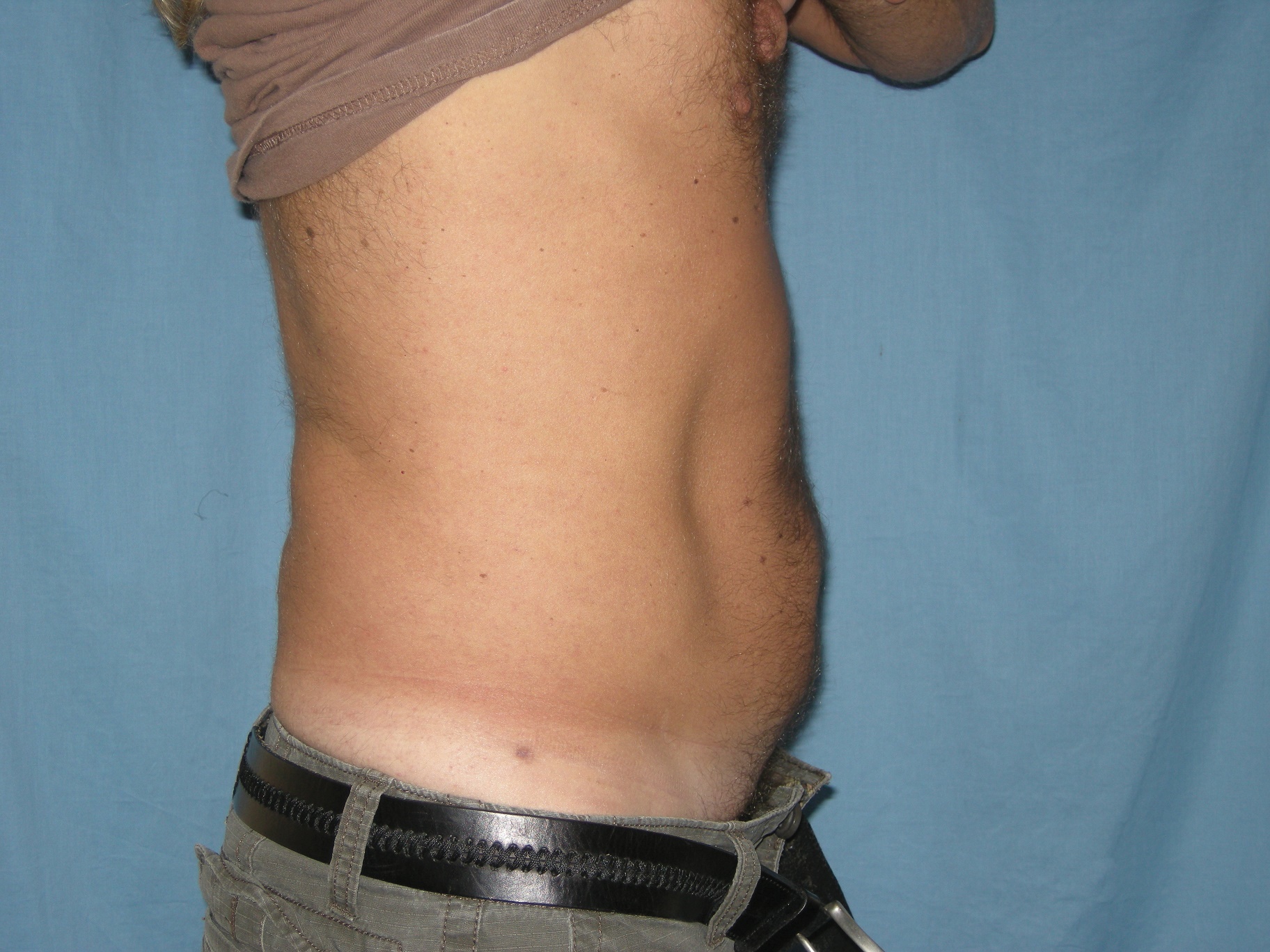 Liposuction Patient Photo - Case 3506 - after view-1