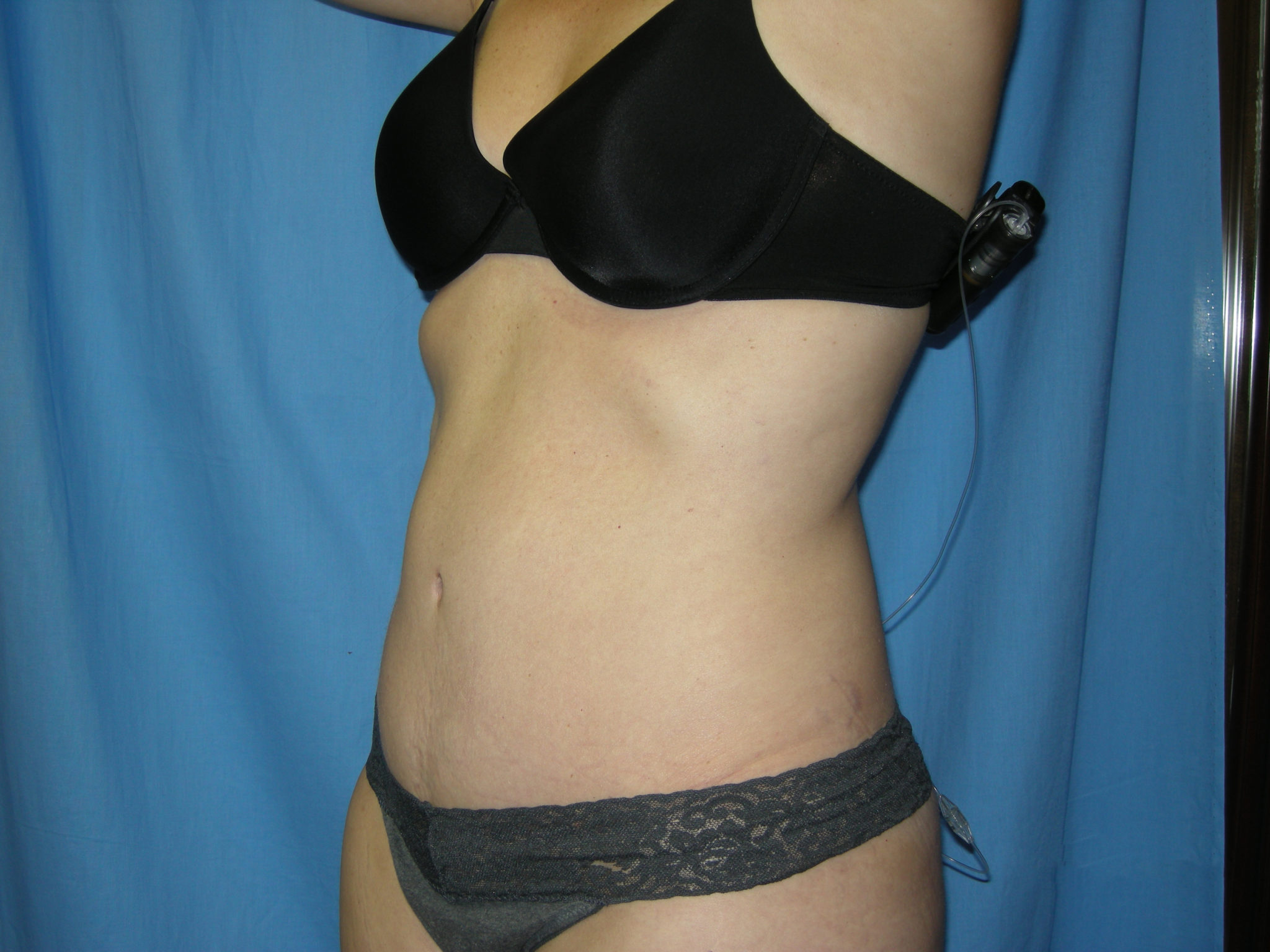 Liposuction Patient Photo - Case 3495 - after view-2
