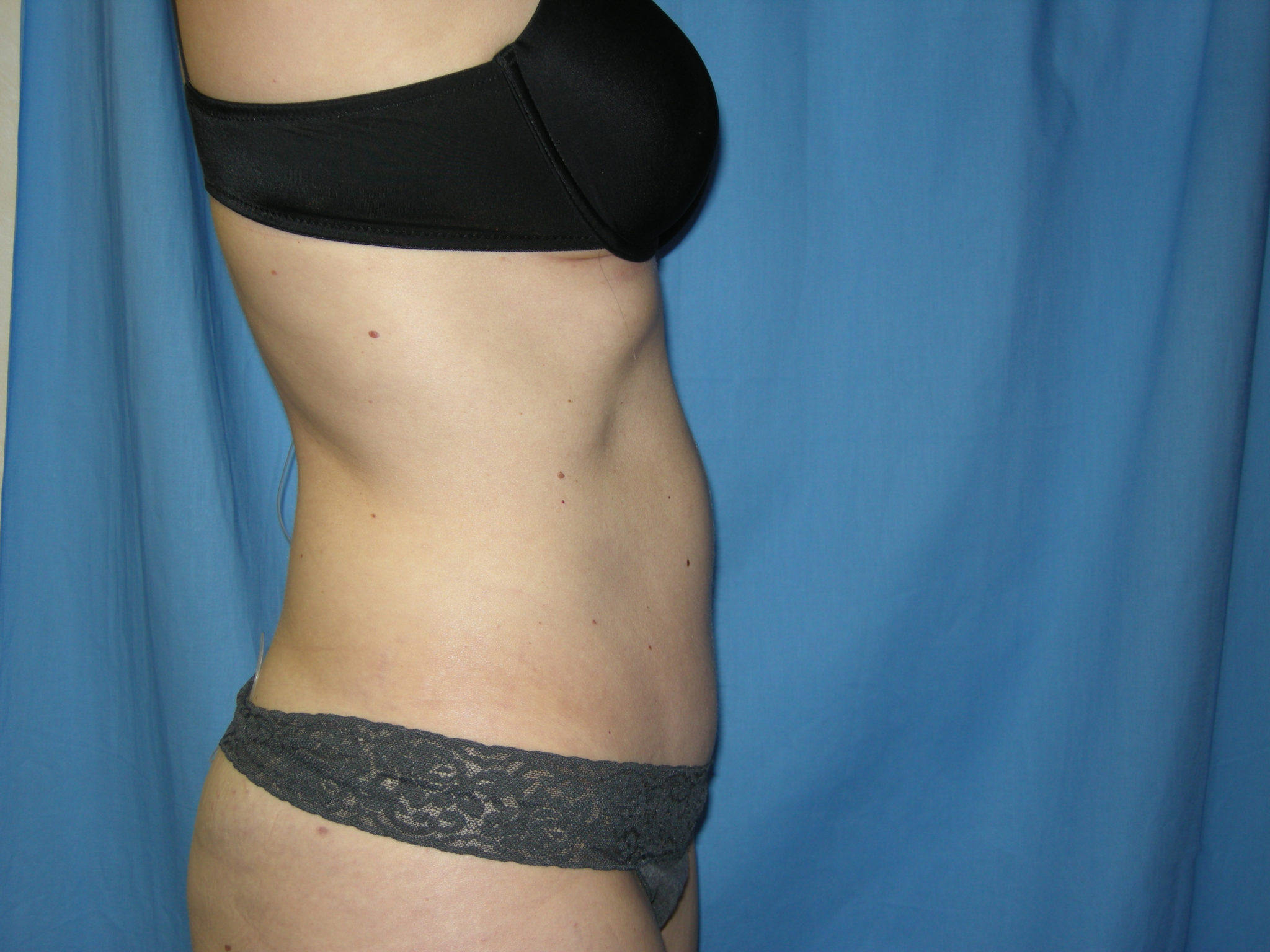 Liposuction Patient Photo - Case 3495 - after view-3