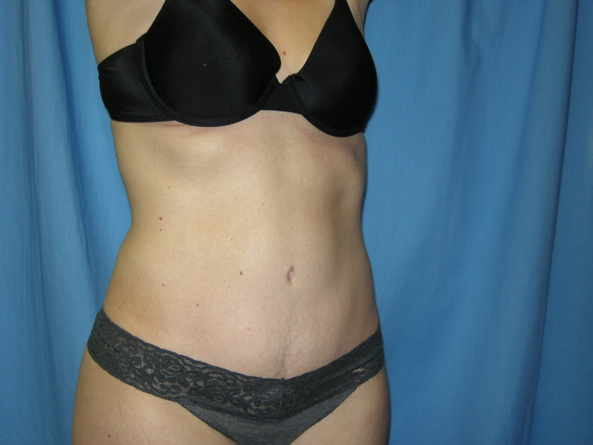 Liposuction Patient Photo - Case 3495 - after view-4