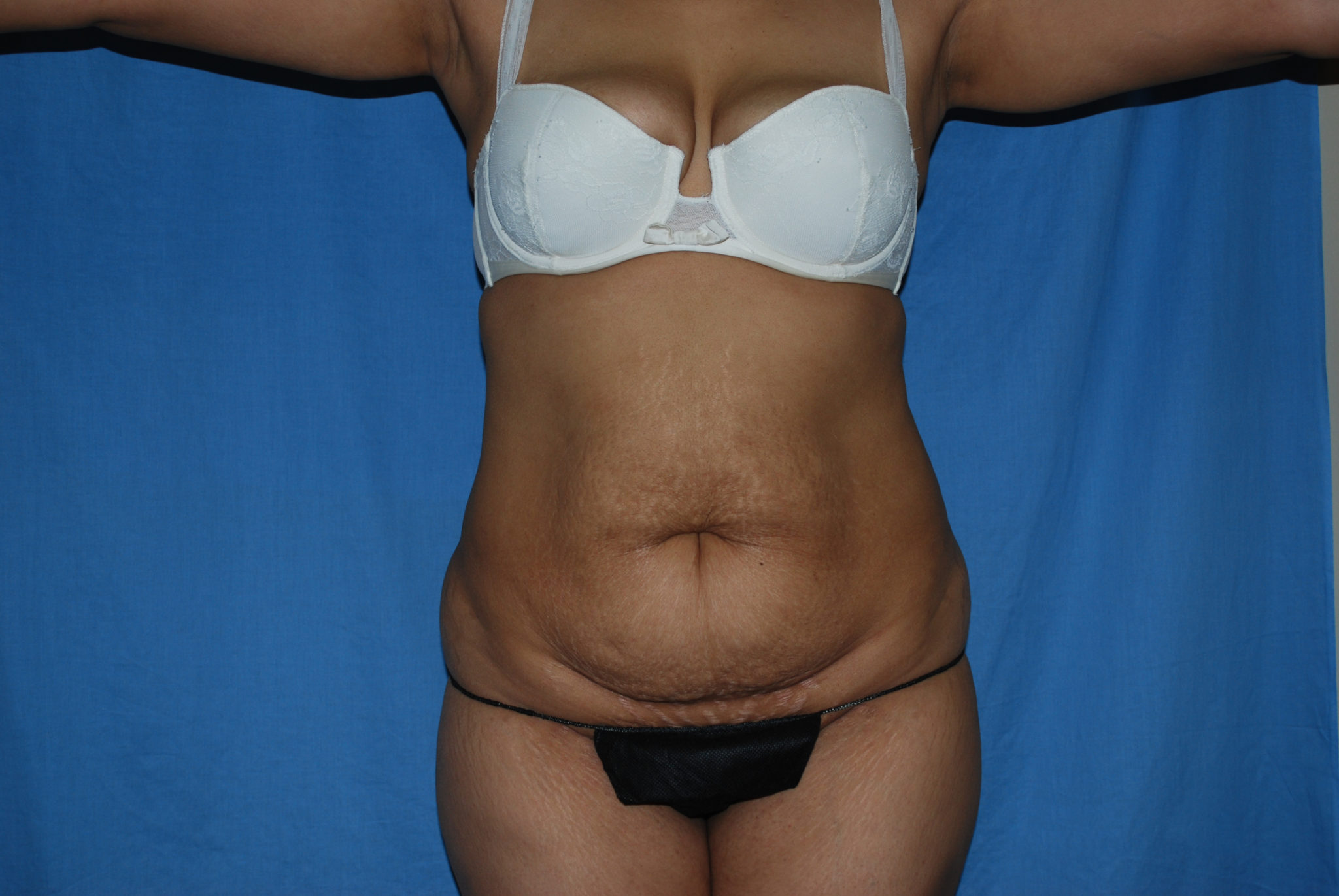 Tummy Tuck Patient Photo - Case 3308 - before view-