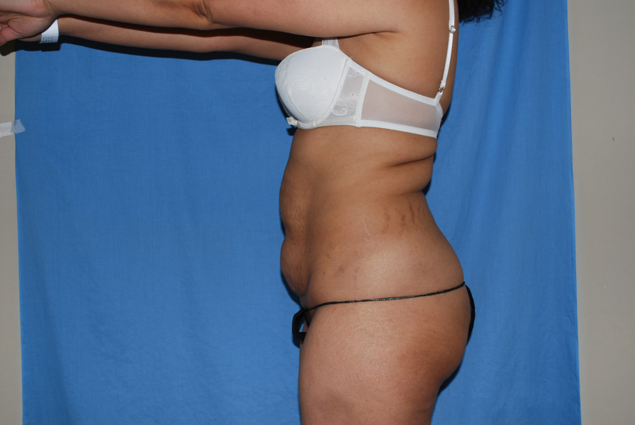 Tummy Tuck Patient Photo - Case 3308 - before view-1