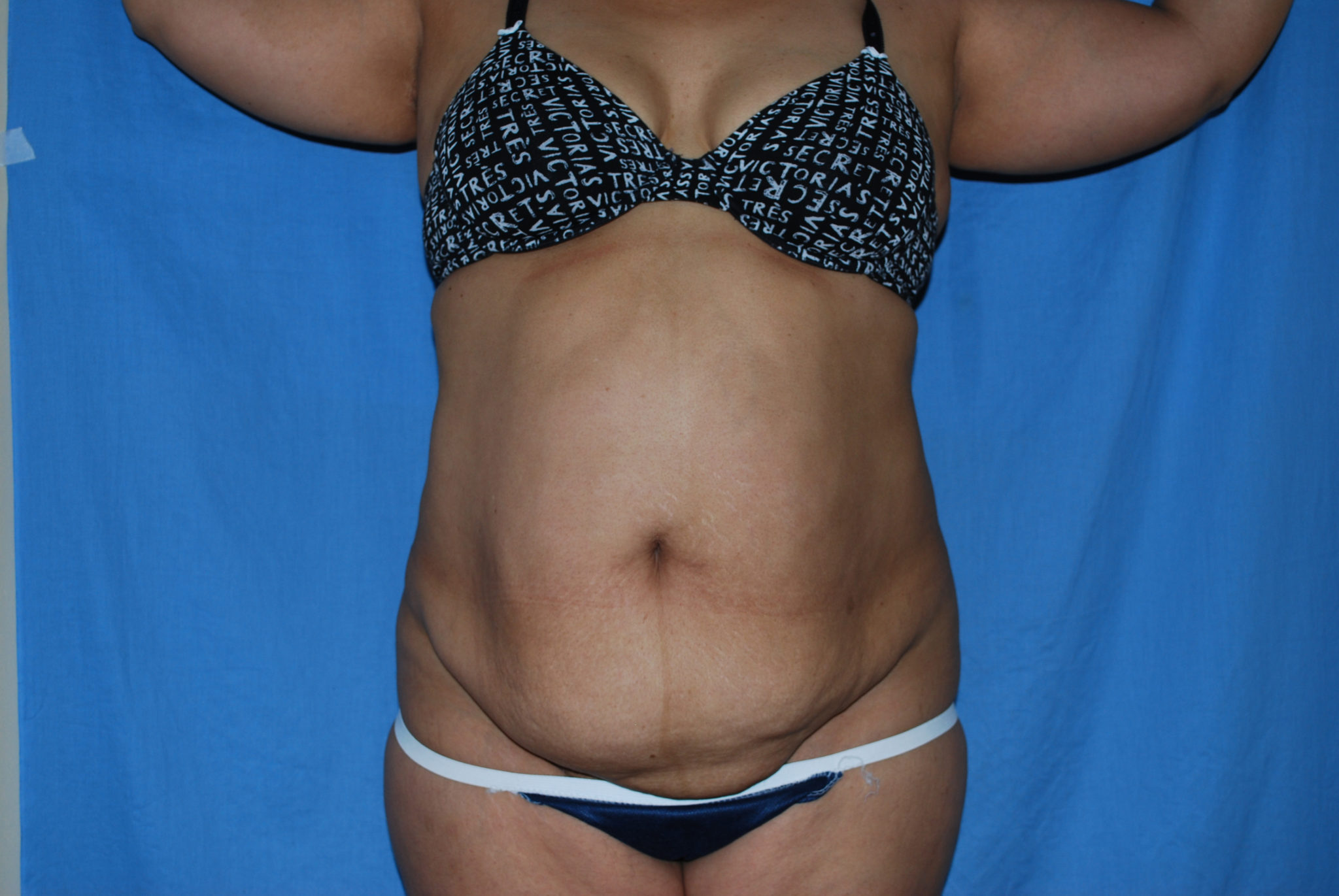 Tummy Tuck Patient Photo - Case 3359 - before view-0