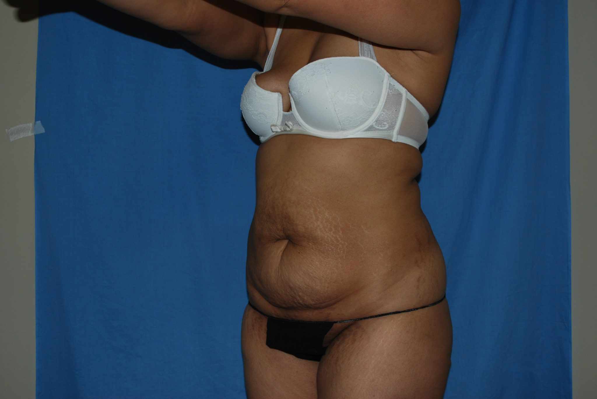 Tummy Tuck Patient Photo - Case 3308 - before view-2