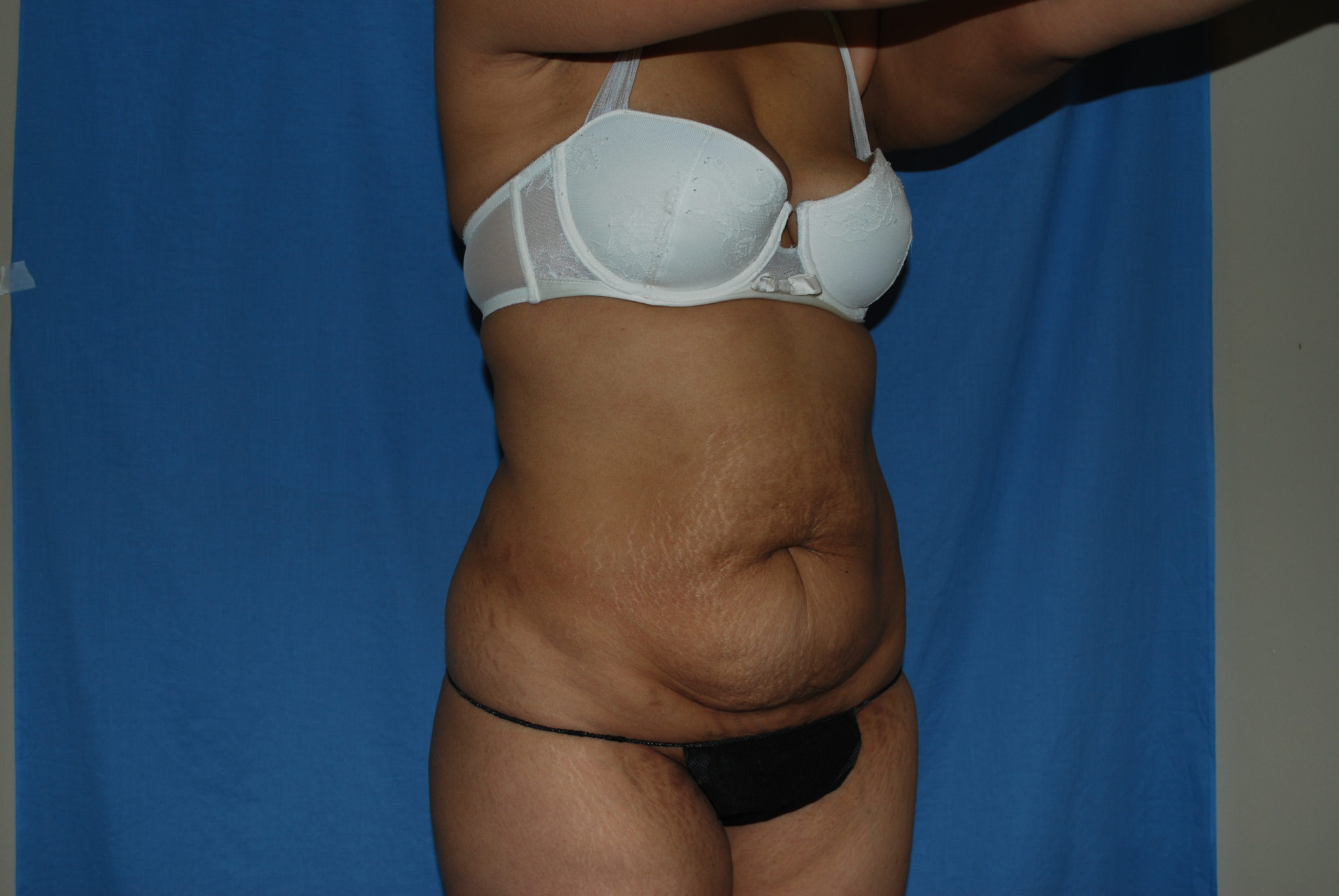 Tummy Tuck Patient Photo - Case 3308 - before view-4
