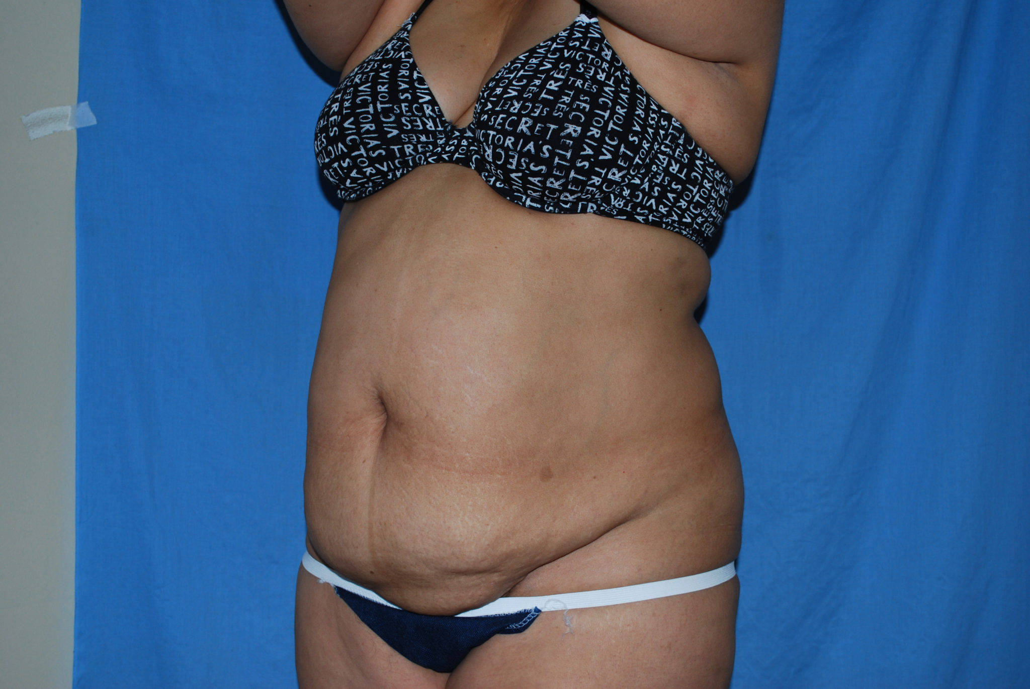 Tummy Tuck Patient Photo - Case 3359 - before view-2