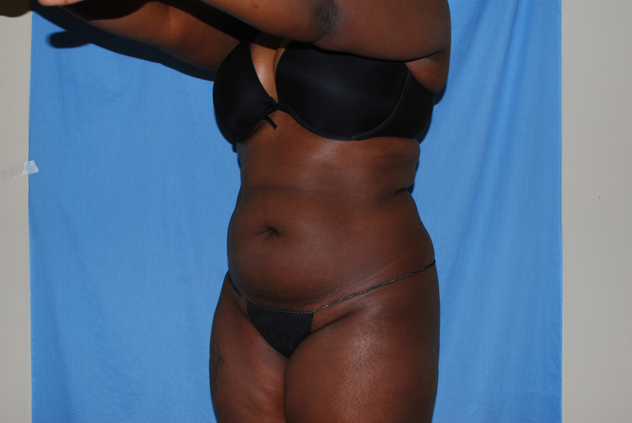 Booty Boost Patient Photo - Case 2982 - before view-3