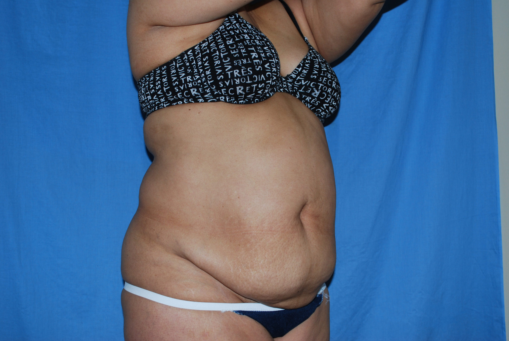 Tummy Tuck Patient Photo - Case 3359 - before view-4