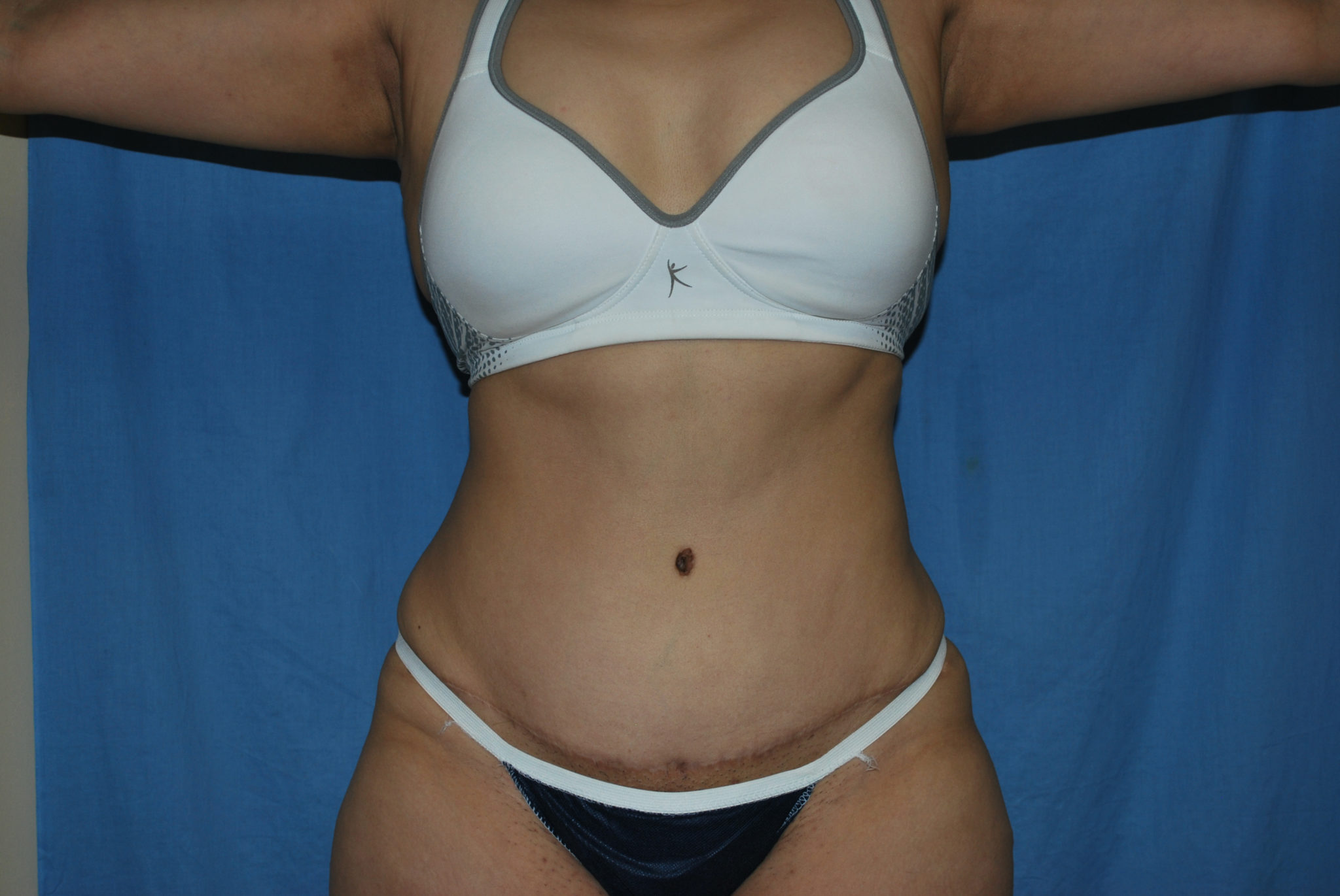 Tummy Tuck Patient Photo - Case 3389 - after view