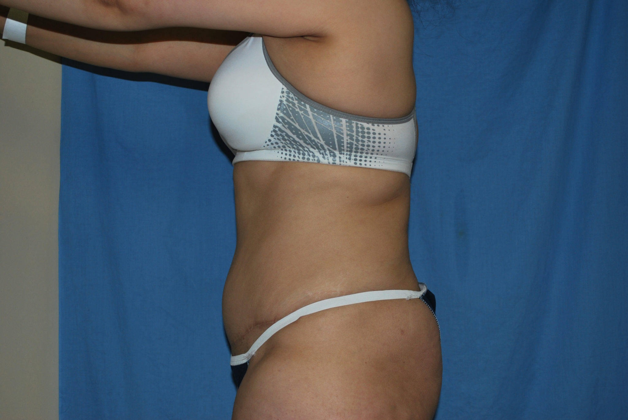 Tummy Tuck Patient Photo - Case 3389 - after view-1